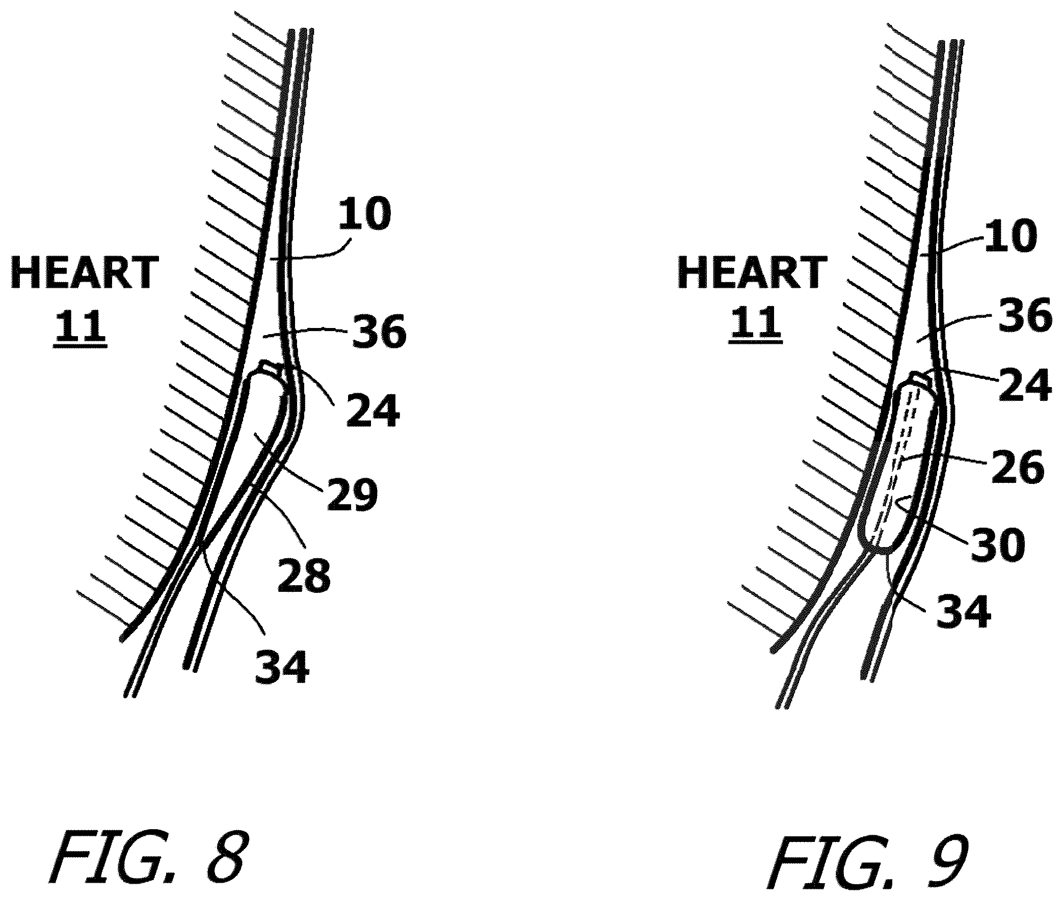 Patent US12377259 Figure 8 – System and method for introducing a construct either on or around the surface of the heart