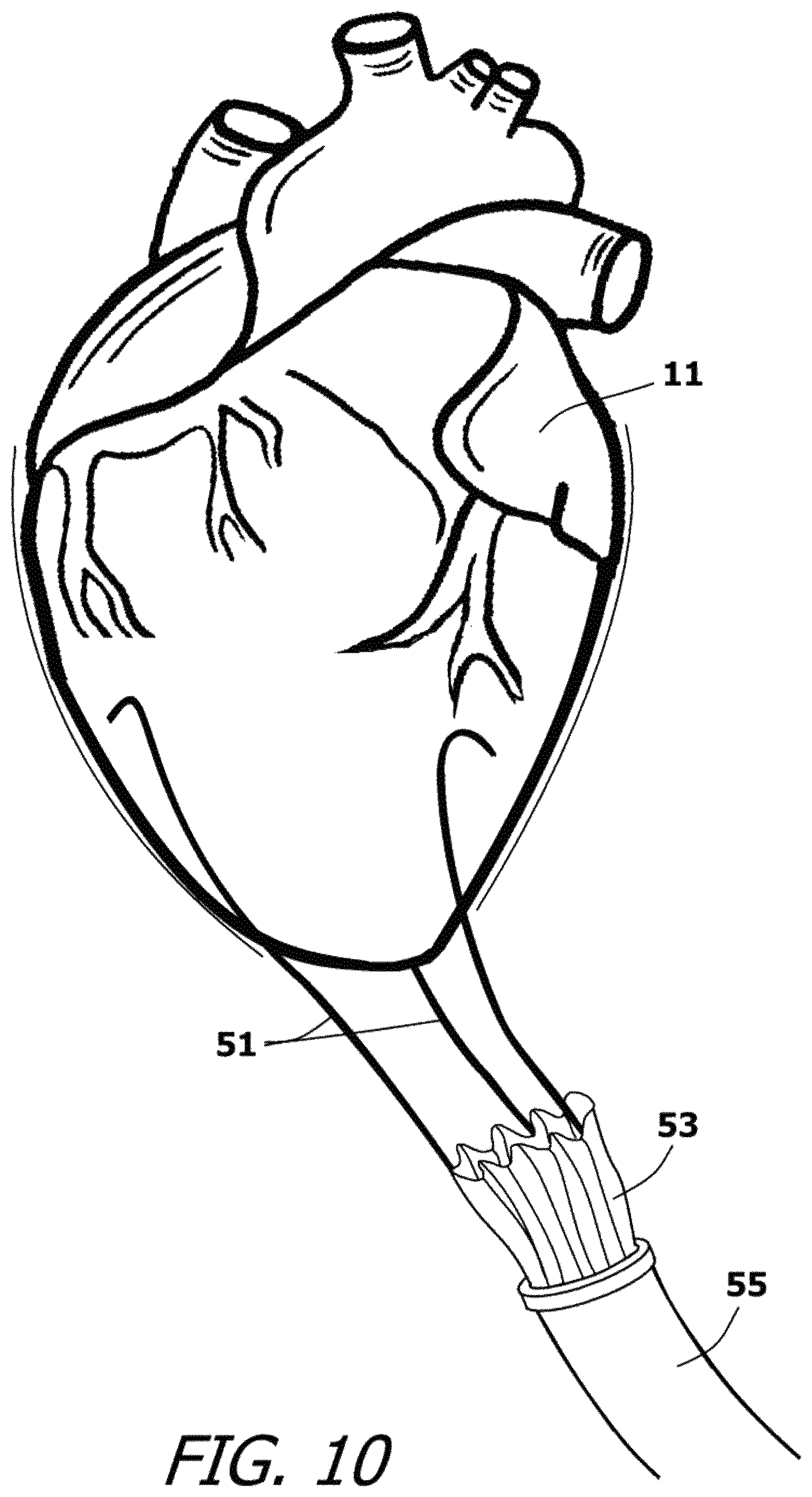 Patent US12377259 Figure 9 – System and method for introducing a construct either on or around the surface of the heart