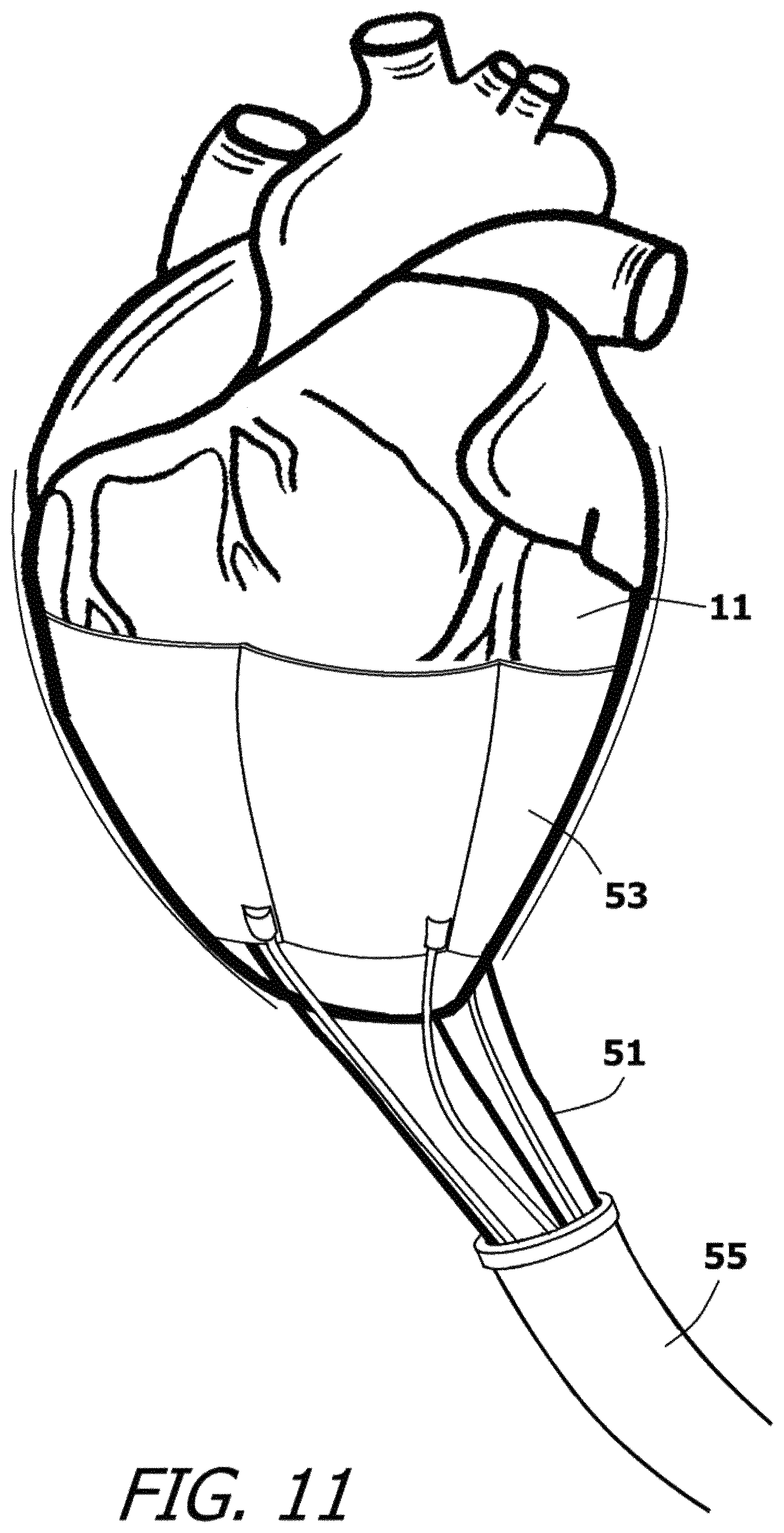 Patent US12377259 Figure 10 – System and method for introducing a construct either on or around the surface of the heart