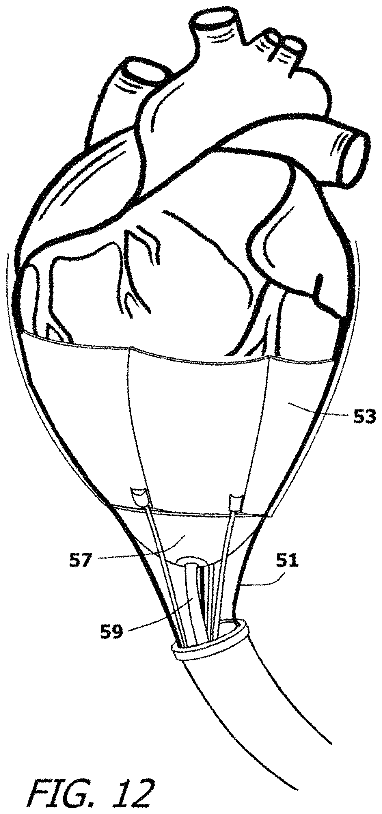 Patent US12377259 Figure 11 – System and method for introducing a construct either on or around the surface of the heart