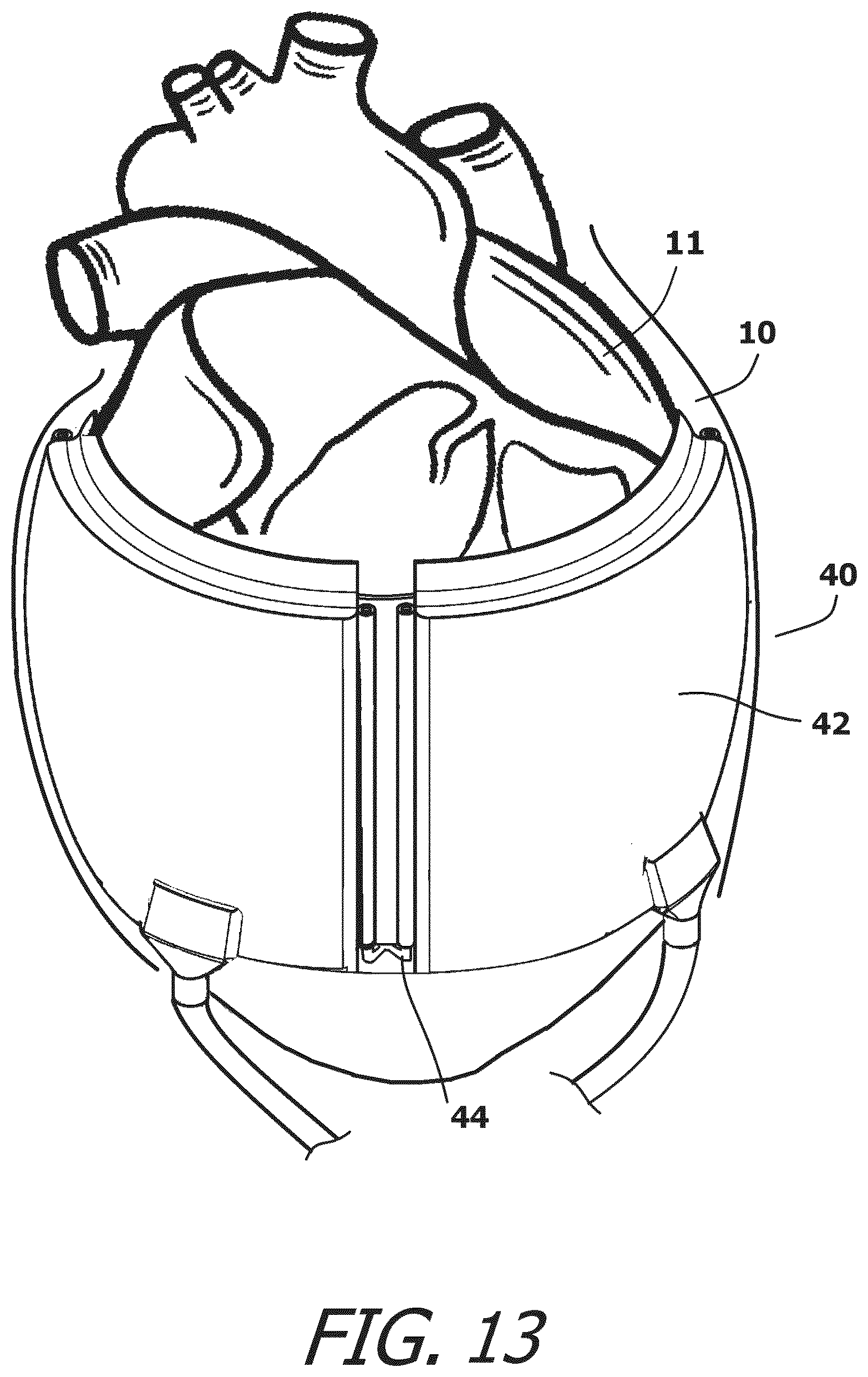 Patent US12377259 Figure 12 – System and method for introducing a construct either on or around the surface of the heart