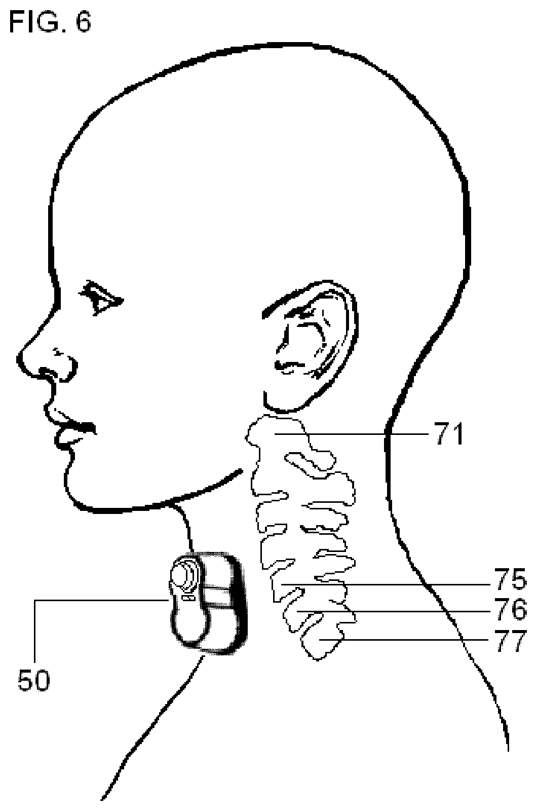 Patent US12377260 Figure 7 – Vagal nerve stimulation
