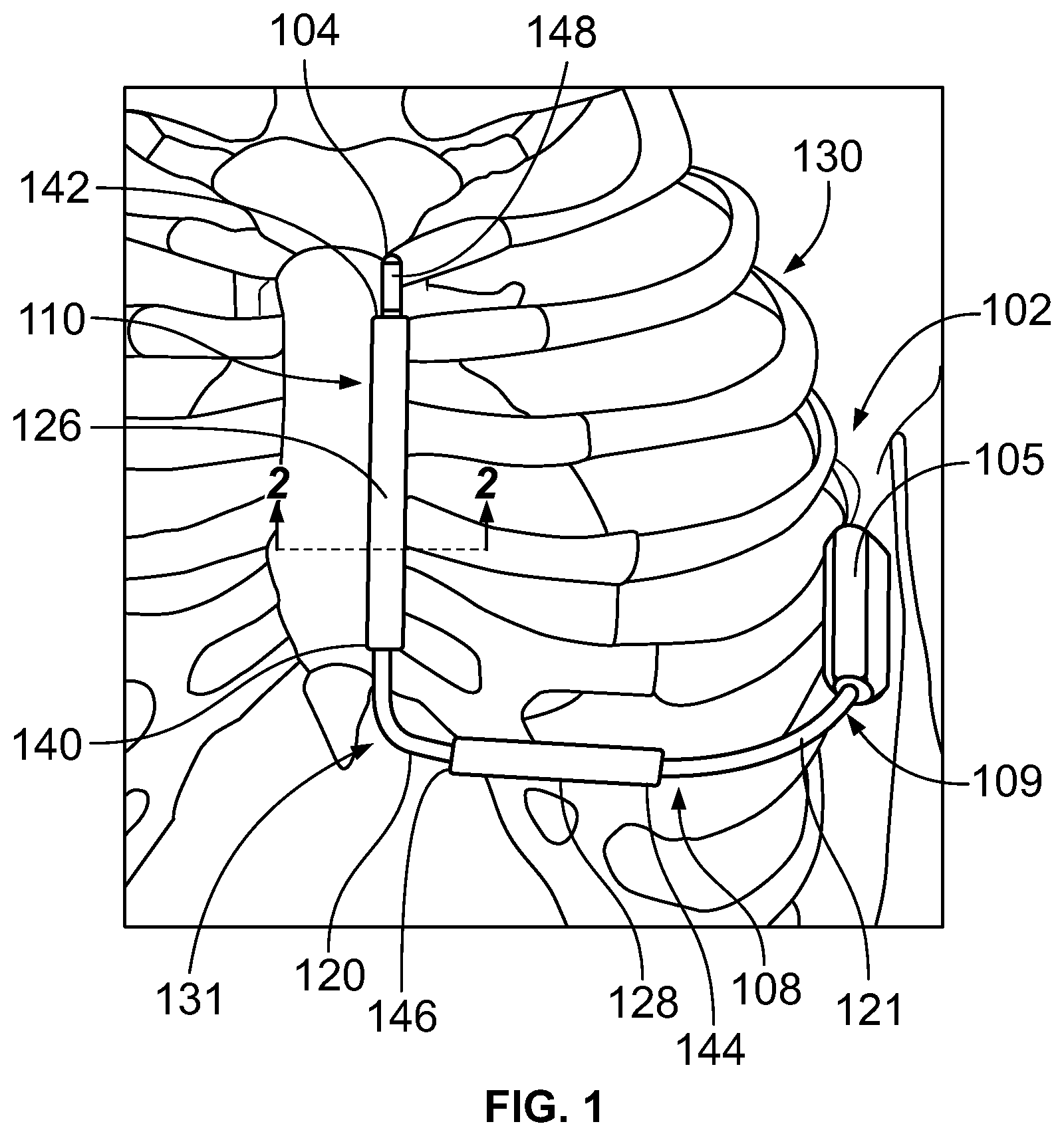 Patent US12377262 Figure 1 – Method and implantable medical device for reducing defibrillation impedance
