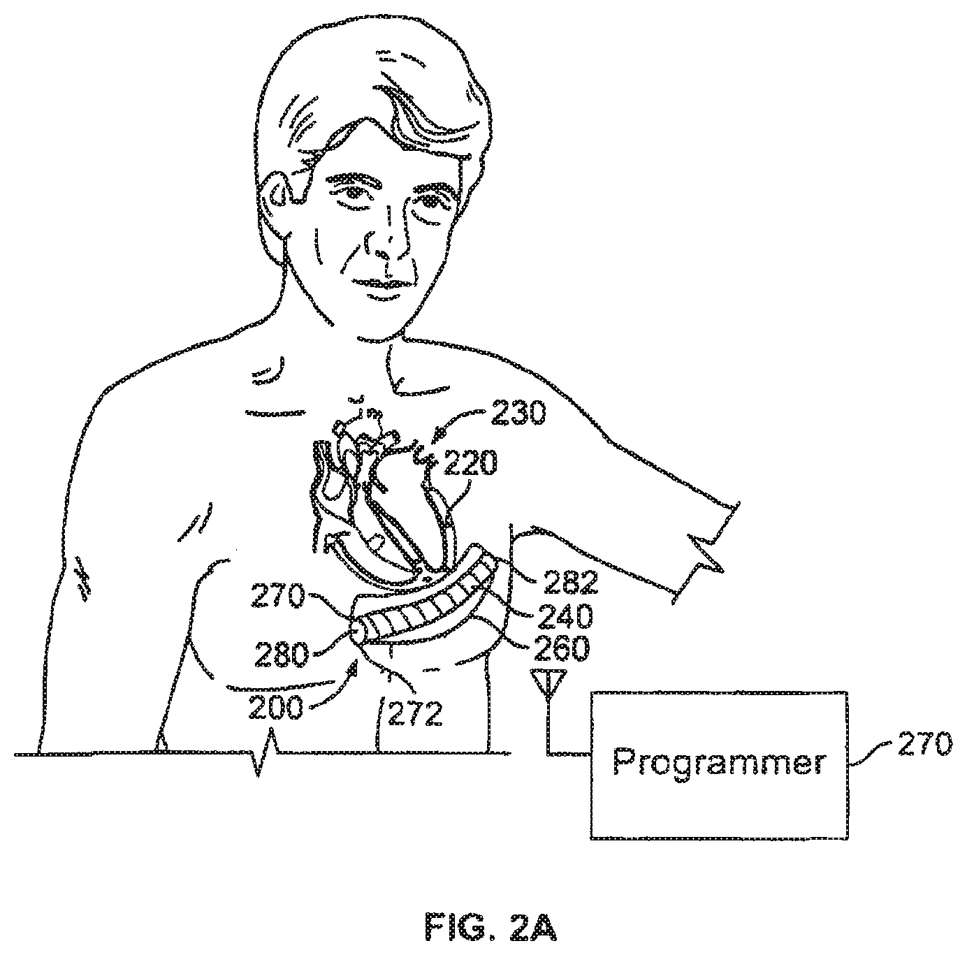 Patent US12377263 Figure 2 – Leadless cardiac stimulation systems