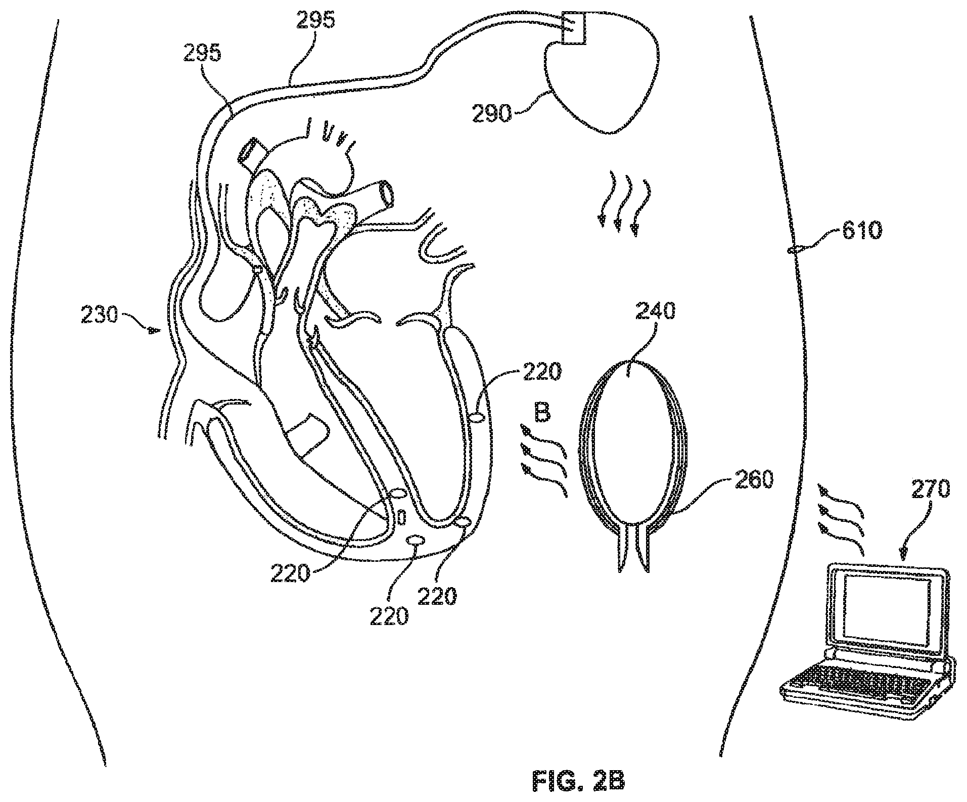Patent US12377263 Figure 3 – Leadless cardiac stimulation systems