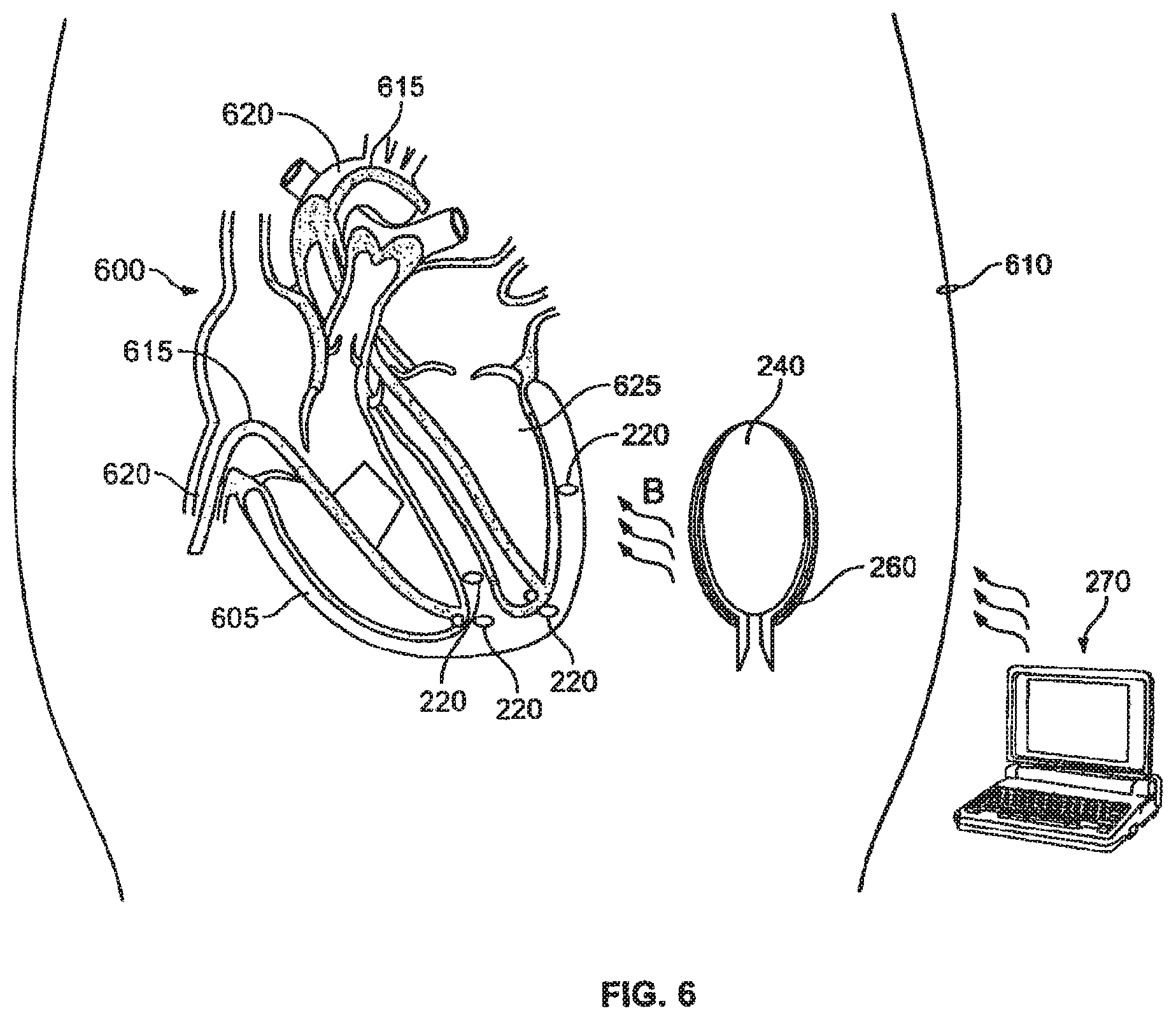 Patent US12377263 Figure 6 – Leadless cardiac stimulation systems