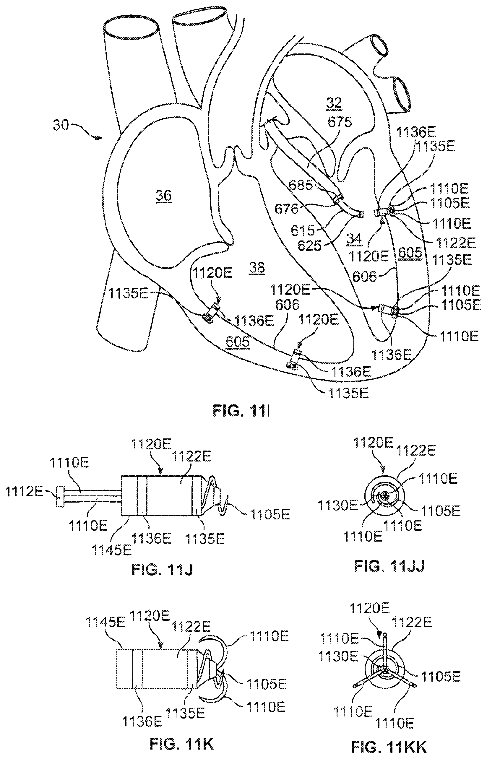 Patent US12377263 Figure 15 – Leadless cardiac stimulation systems