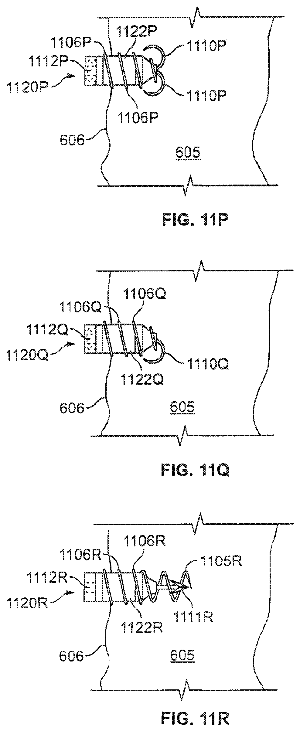 Patent US12377263 Figure 17 – Leadless cardiac stimulation systems