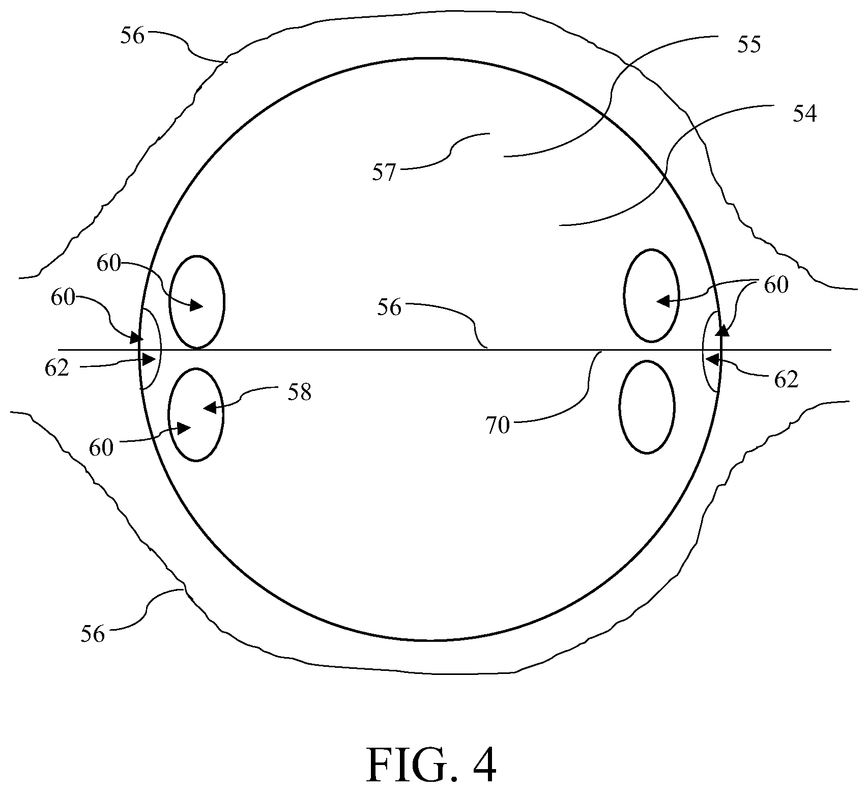 Patent US12377265 Figure 5 – Nonconductive field guide for resection cavity, and systems and methods of using same