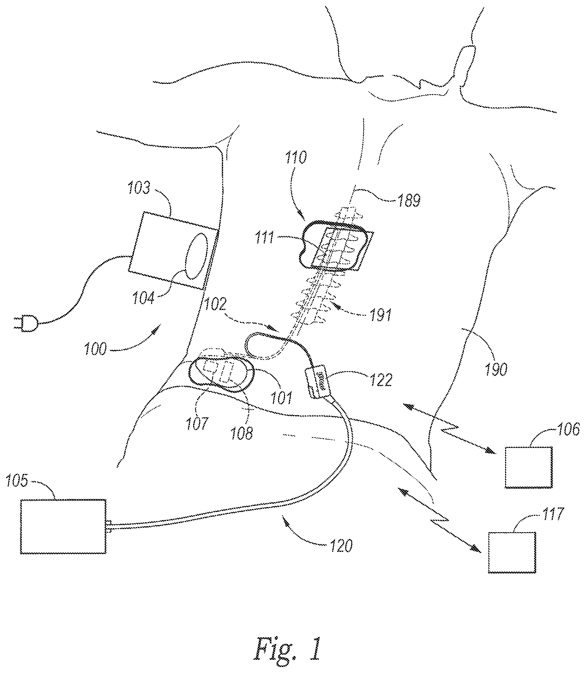 Patent US12377271 Figure 1 – Medical device communication and charging assemblies for use with implantable signal generators, and associated systems and methods