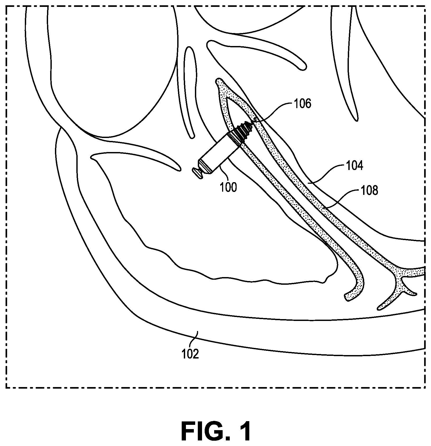 Patent US12377277 Figure 1 – Biostimulator having burrowing nose