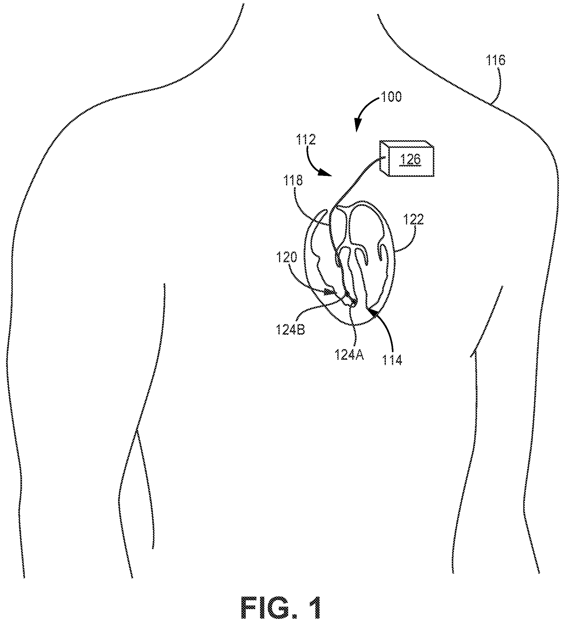 Patent US12377278 Figure 1 – Polymeric enclosure for implantable medical device