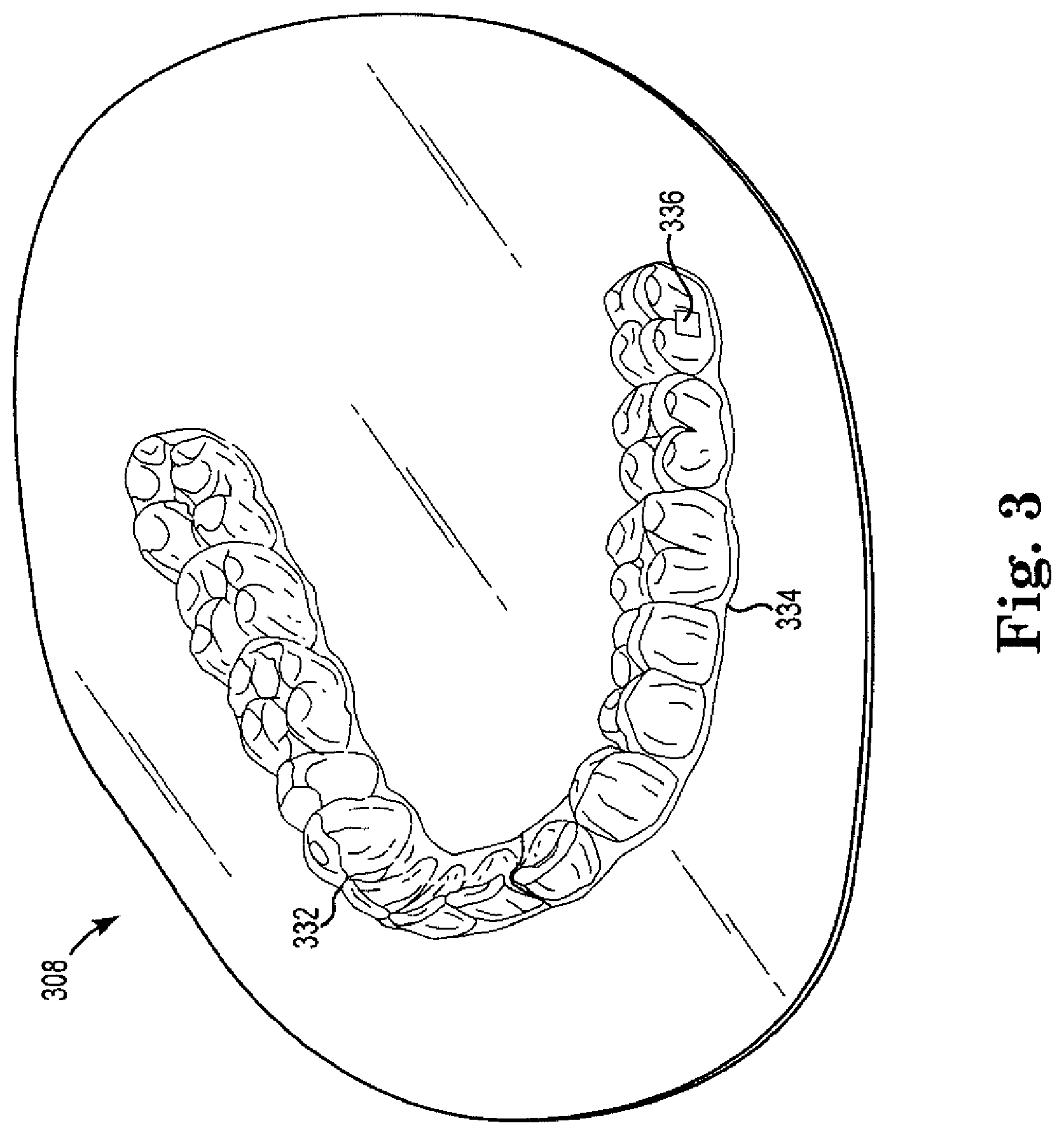 Patent US12377493 Figure 3 – Laser cutting