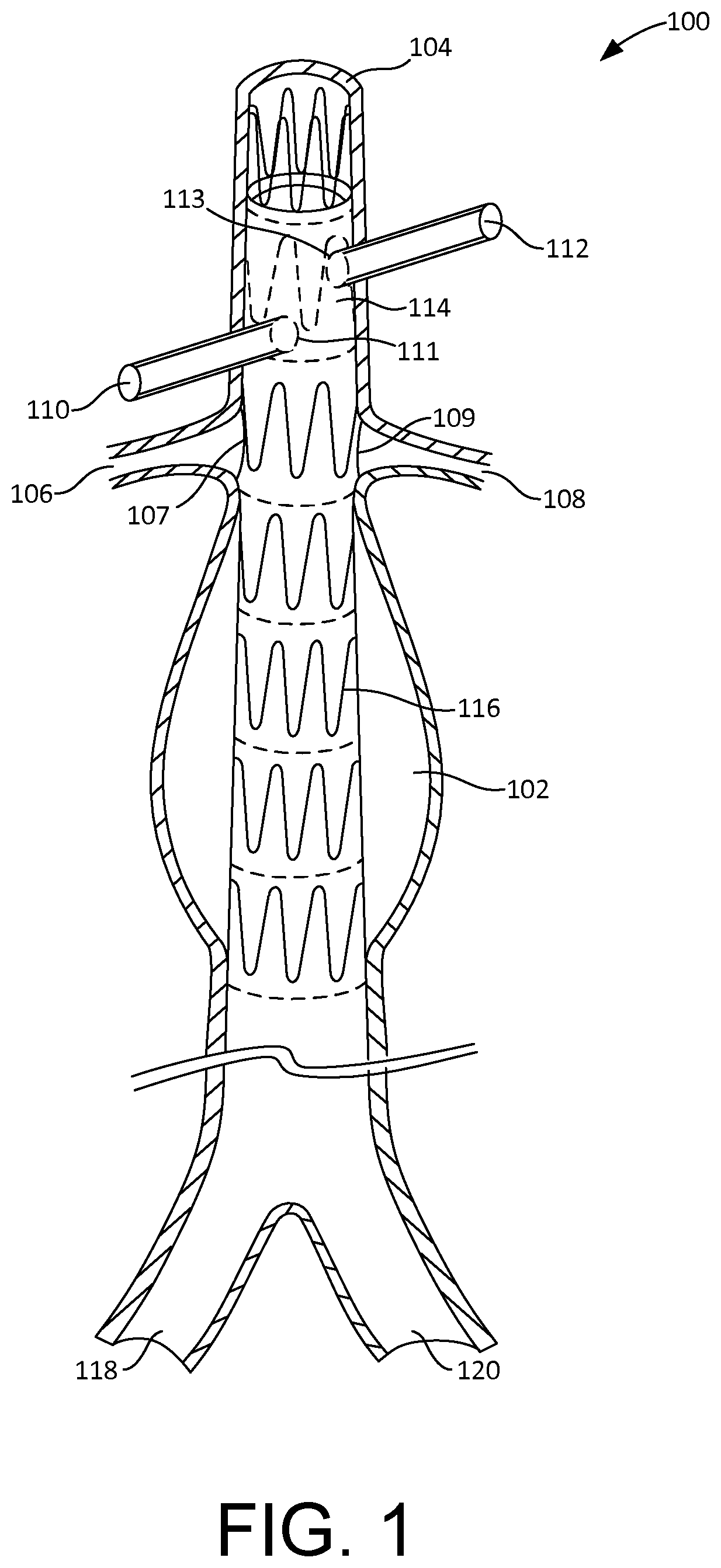 Patent US12377609 Figure 1 – Fenestration template for endovascular repair of aortic aneurysms