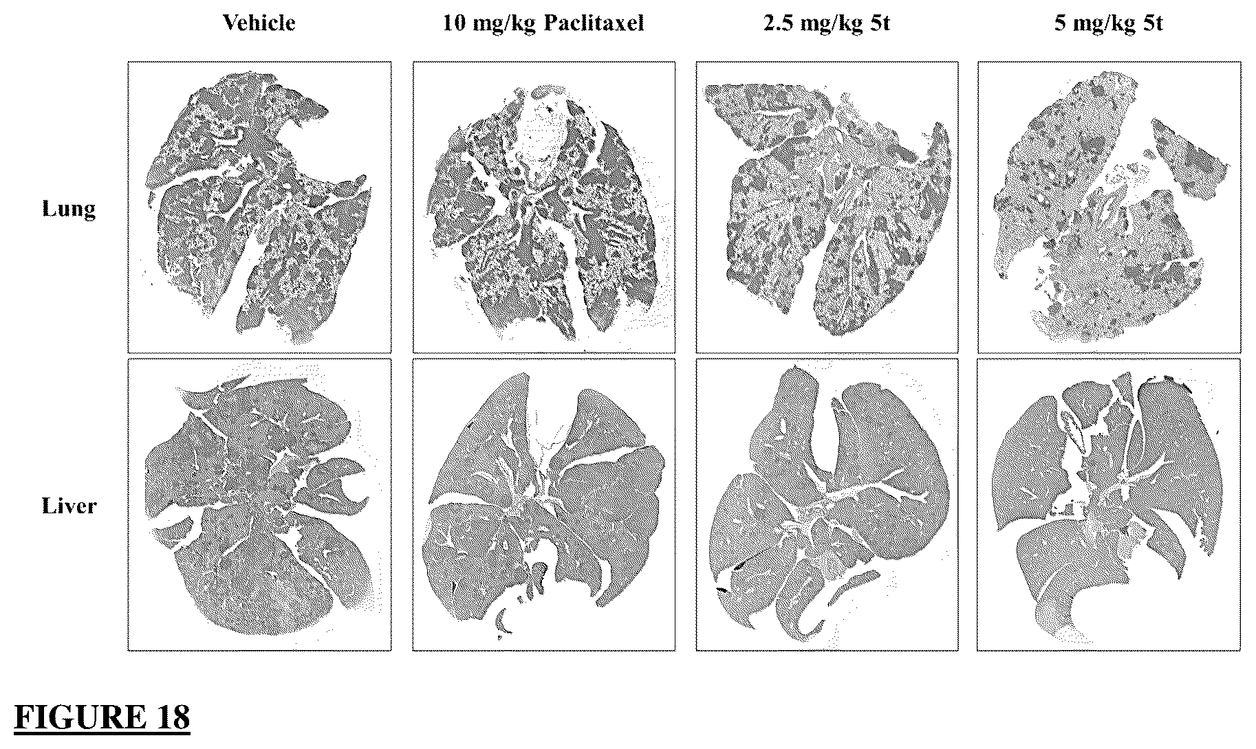 Patent US12378257 Figure 17 – Metabolically stable pyrimidinyl dihydroquinoxalinones as tubulin polymerization inhibitors
