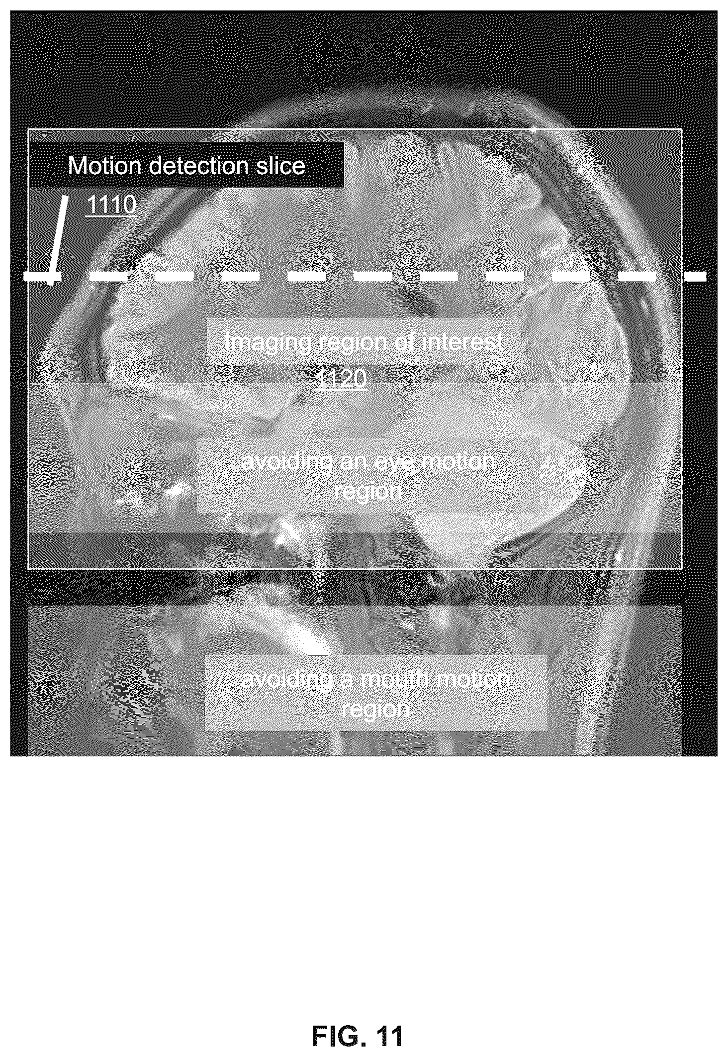 Patent US12386004 Figure 11 – Methods and systems for motion detection in magnetic resonance imaging