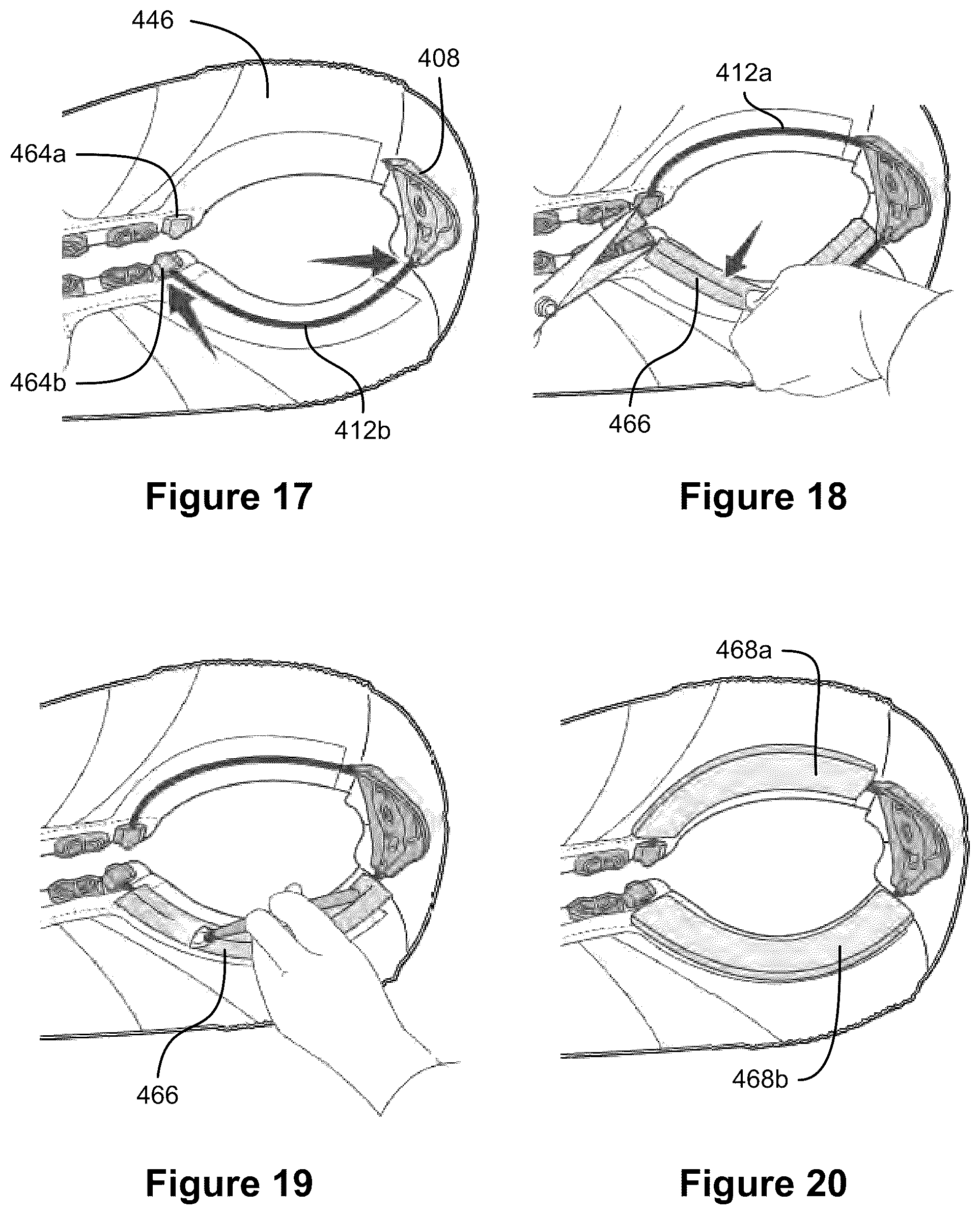 Patent US12396521 Figure 11 – Tightening mechanisms and applications including the same
