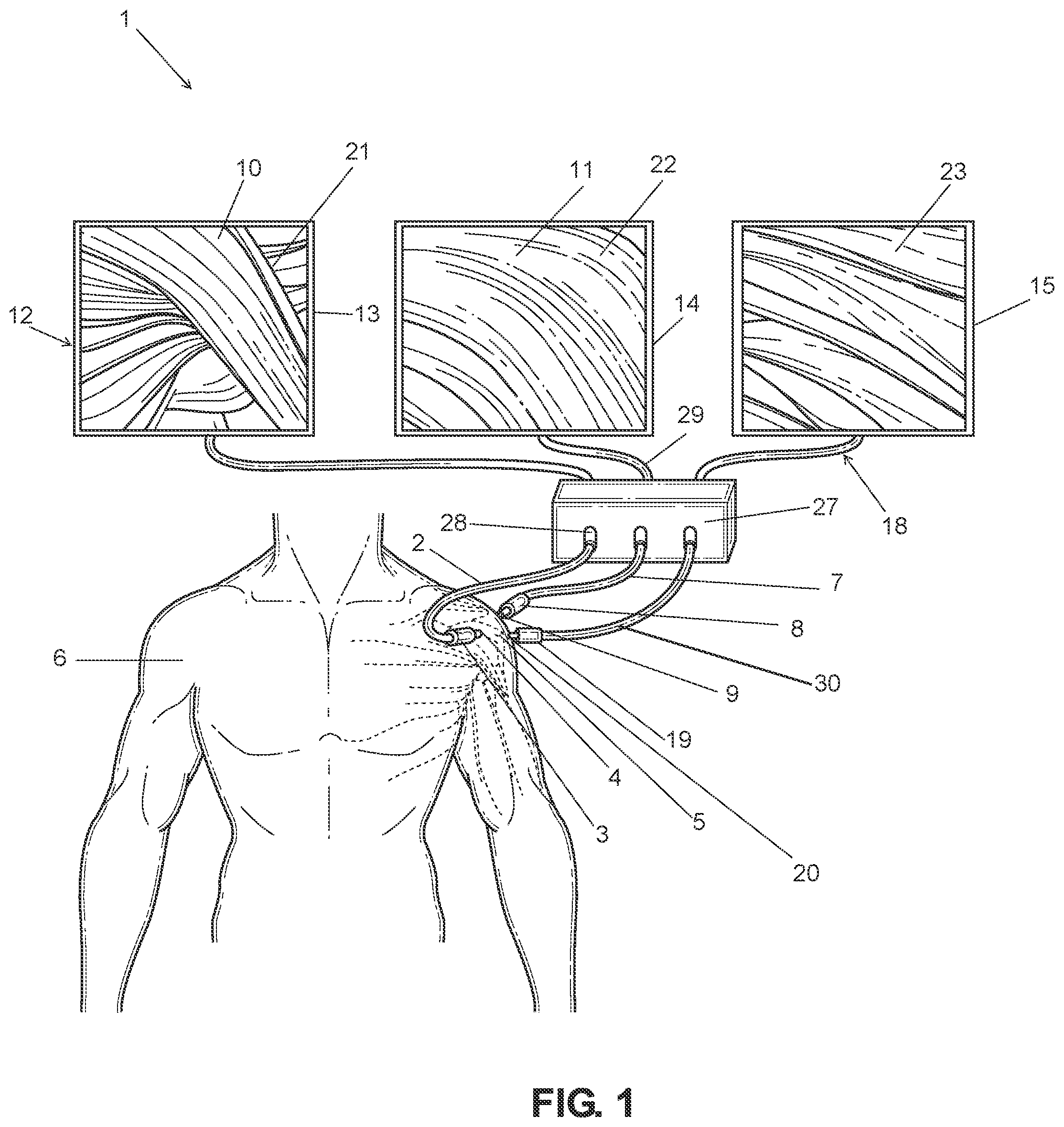 Patent US12396632 Figure 1 – Enhanced visualization methods and systems for endoscopic procedures
