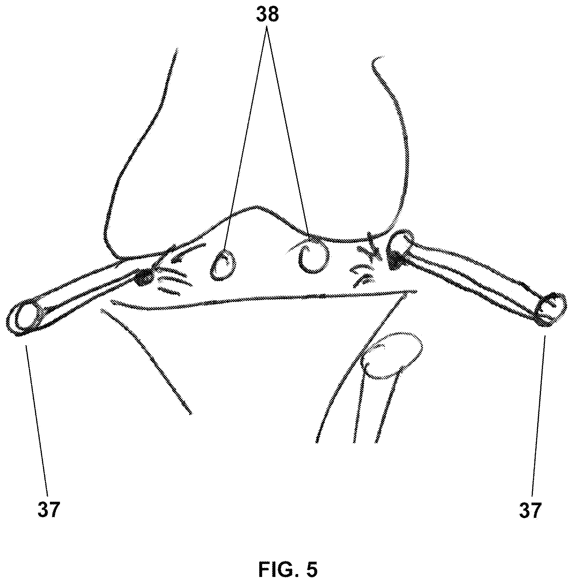 Patent US12396632 Figure 4 – Enhanced visualization methods and systems for endoscopic procedures