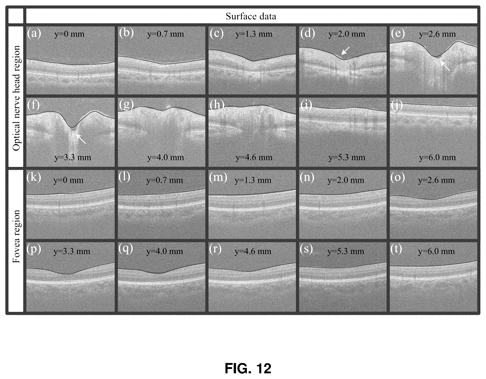 Patent US12396643 Figure 11 – Systems and methods for performing Gabor optical coherence tomographic angiography