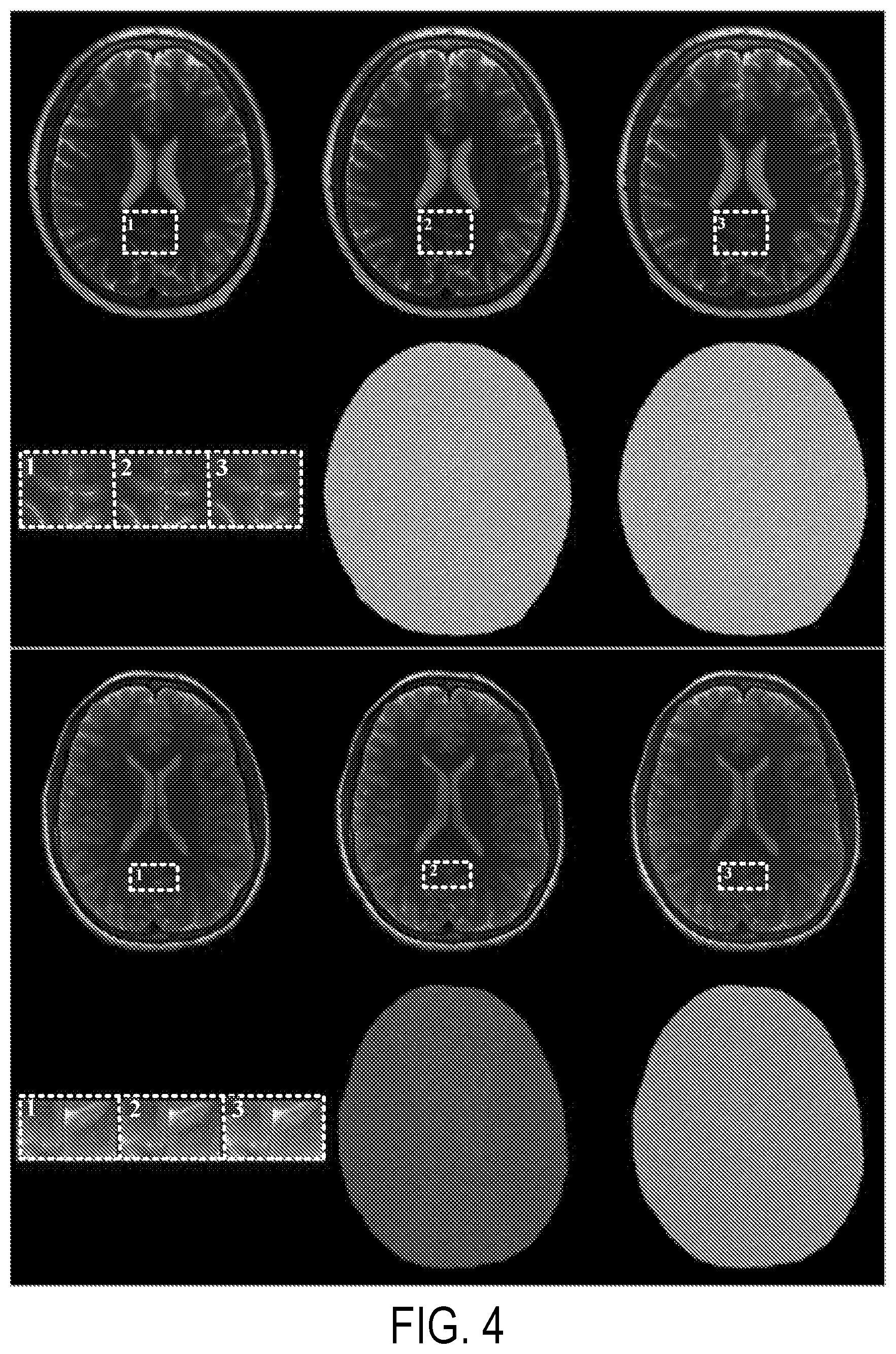 Patent US12396654 Figure 4 – Reconstruction augmentation by constraining with intensity gradients in MRI