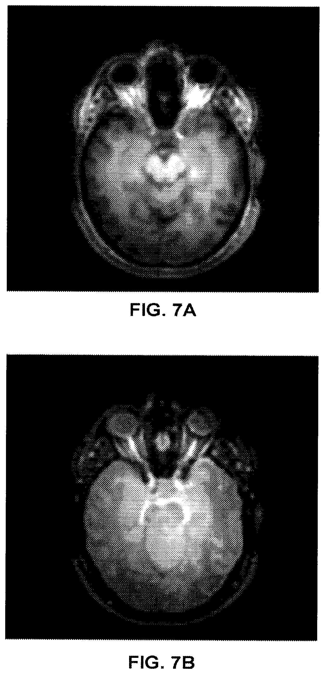 Patent US12396655 Figure 5 – Robust and computationally efficient missing point and phase estimation for FID sequences