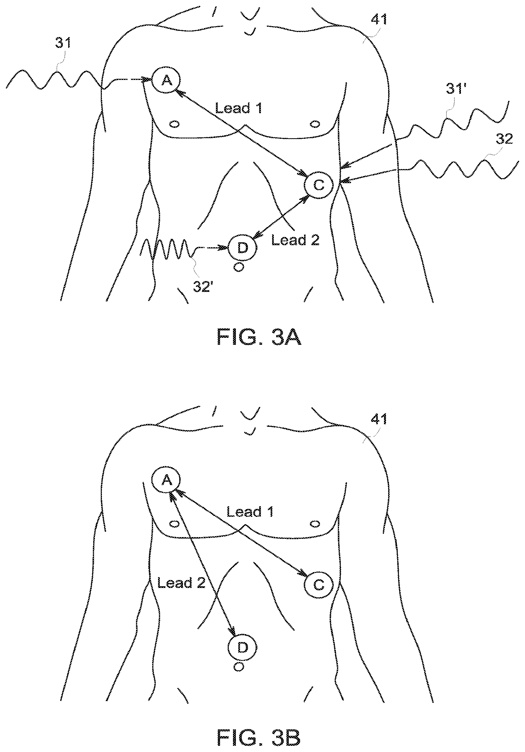 Patent US12396658 Figure 4 – System and method for apnea detection