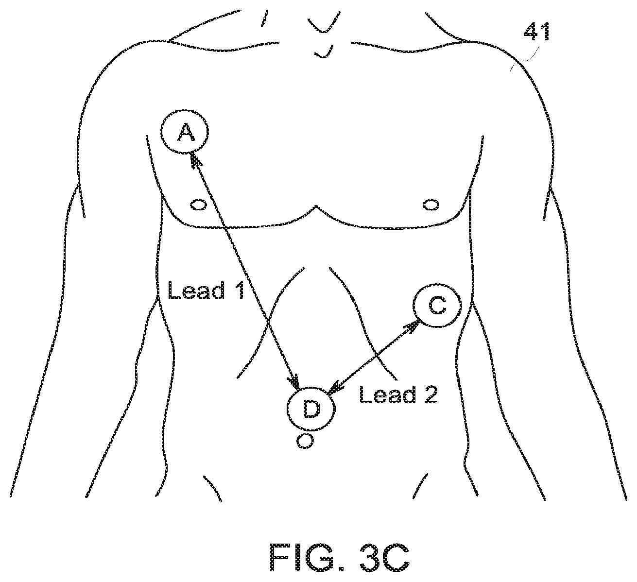 Patent US12396658 Figure 5 – System and method for apnea detection