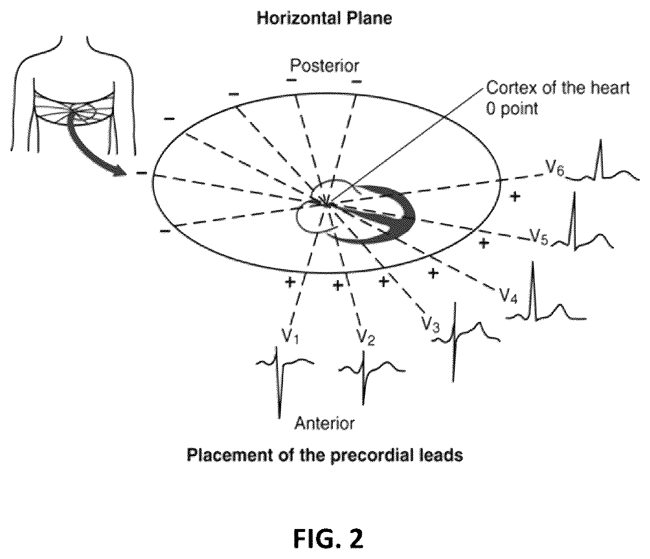 Patent US12396671 Figure 2 – ECG monitor device with electrode pad