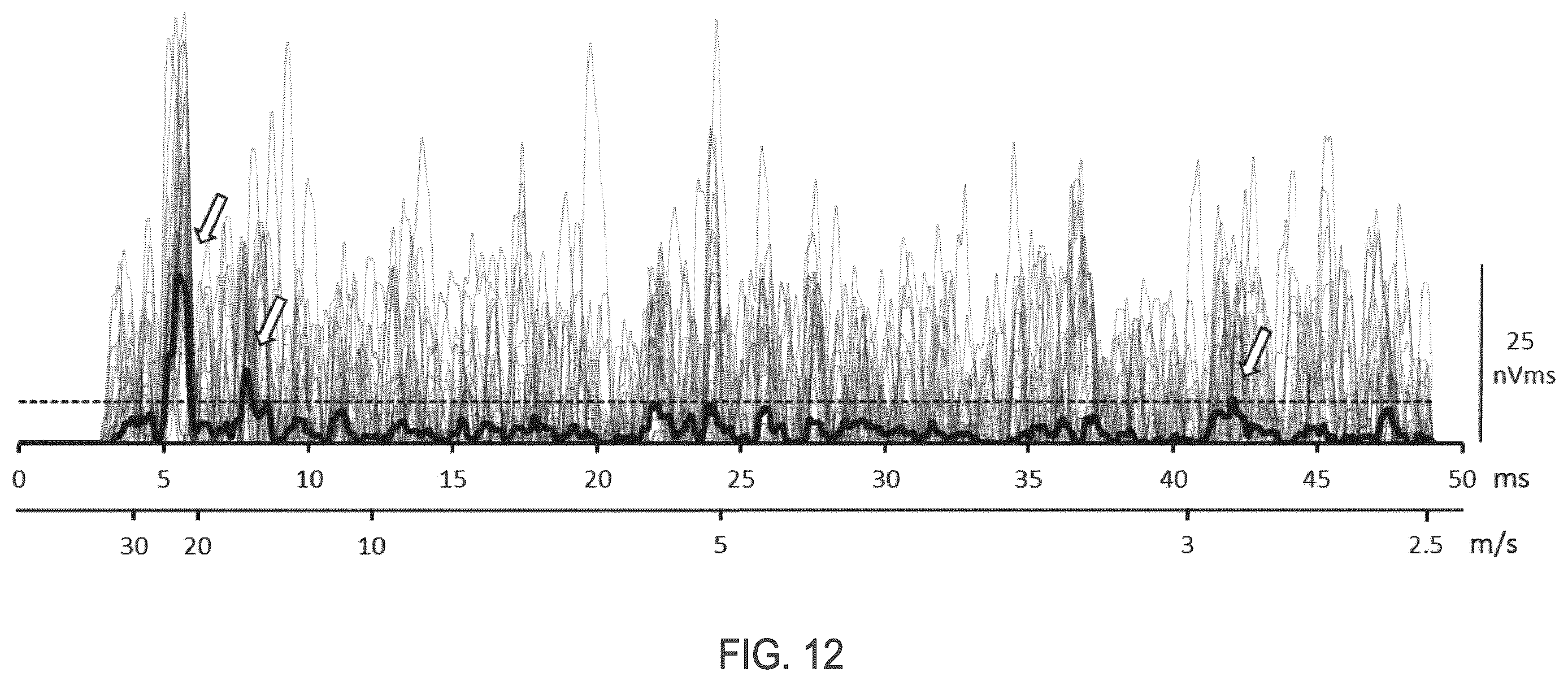Patent US12396673 Figure 11 – Systems and methods for differentiating stimulus-evoked events from noise by analysis of two time series