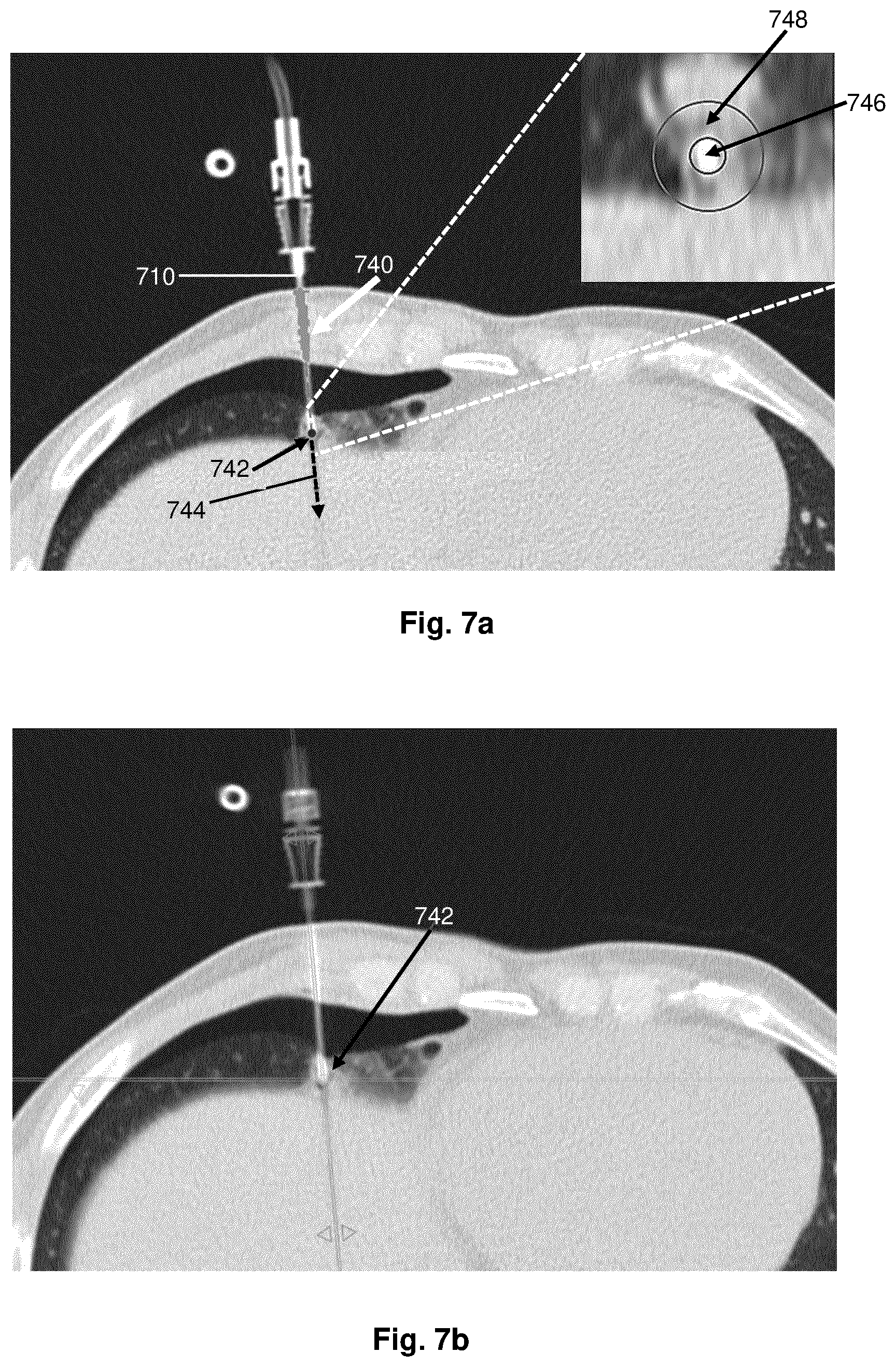 Patent US12396689 Figure 5 – Determining needle position