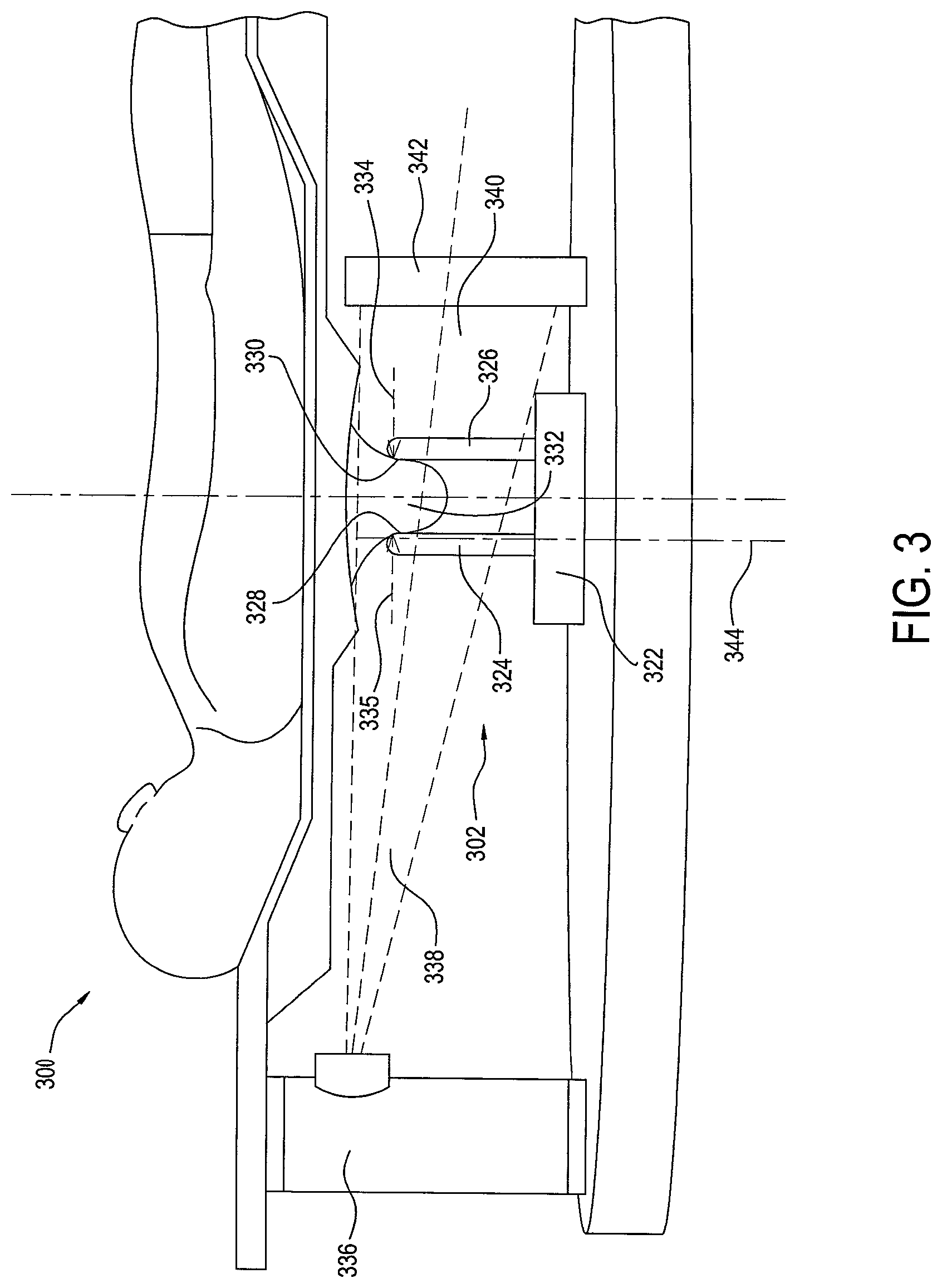 Patent US12396694 Figure 3 – Stationary detail imaging in cone beam breast computed tomography