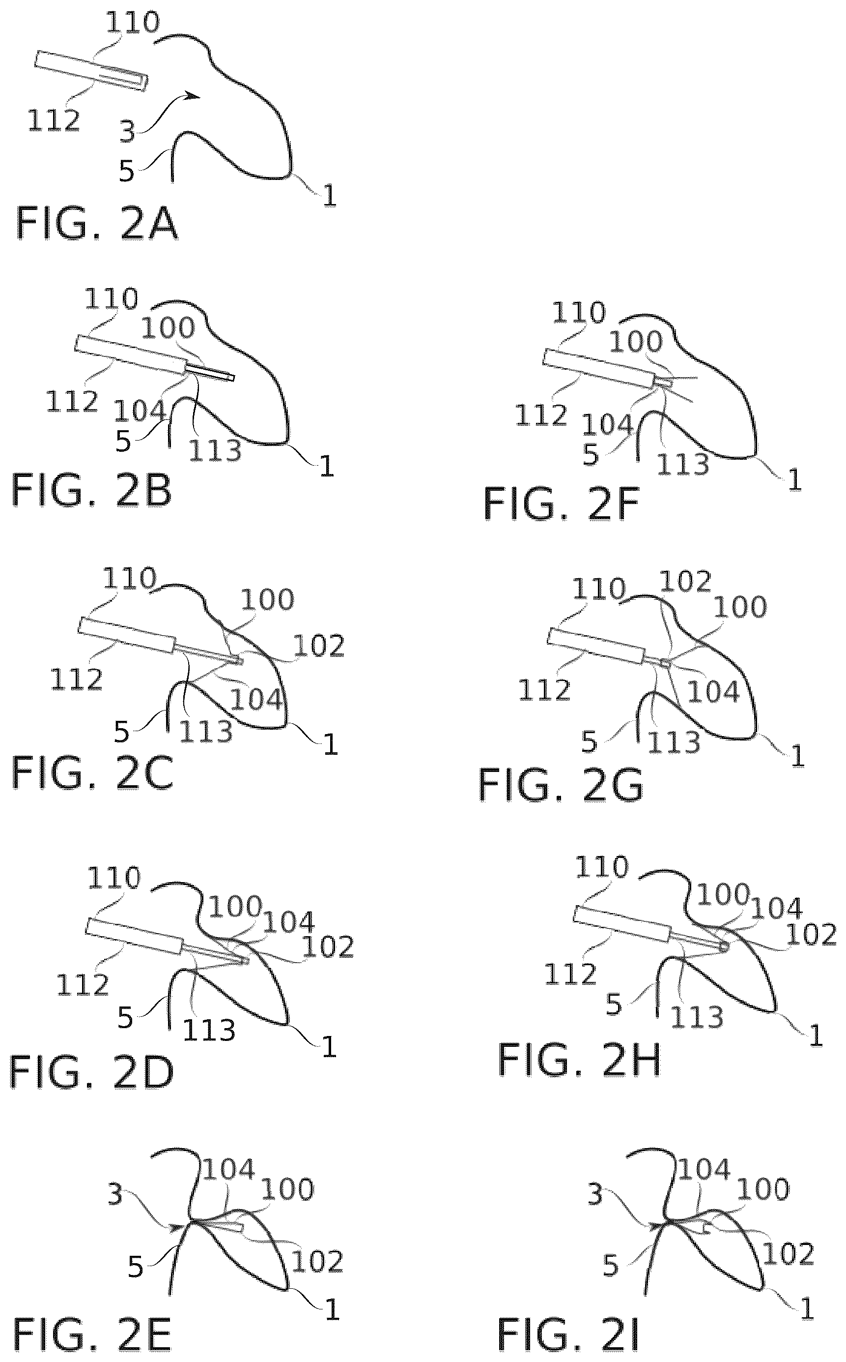 Patent US12396712 Figure 5 – Suturing clip