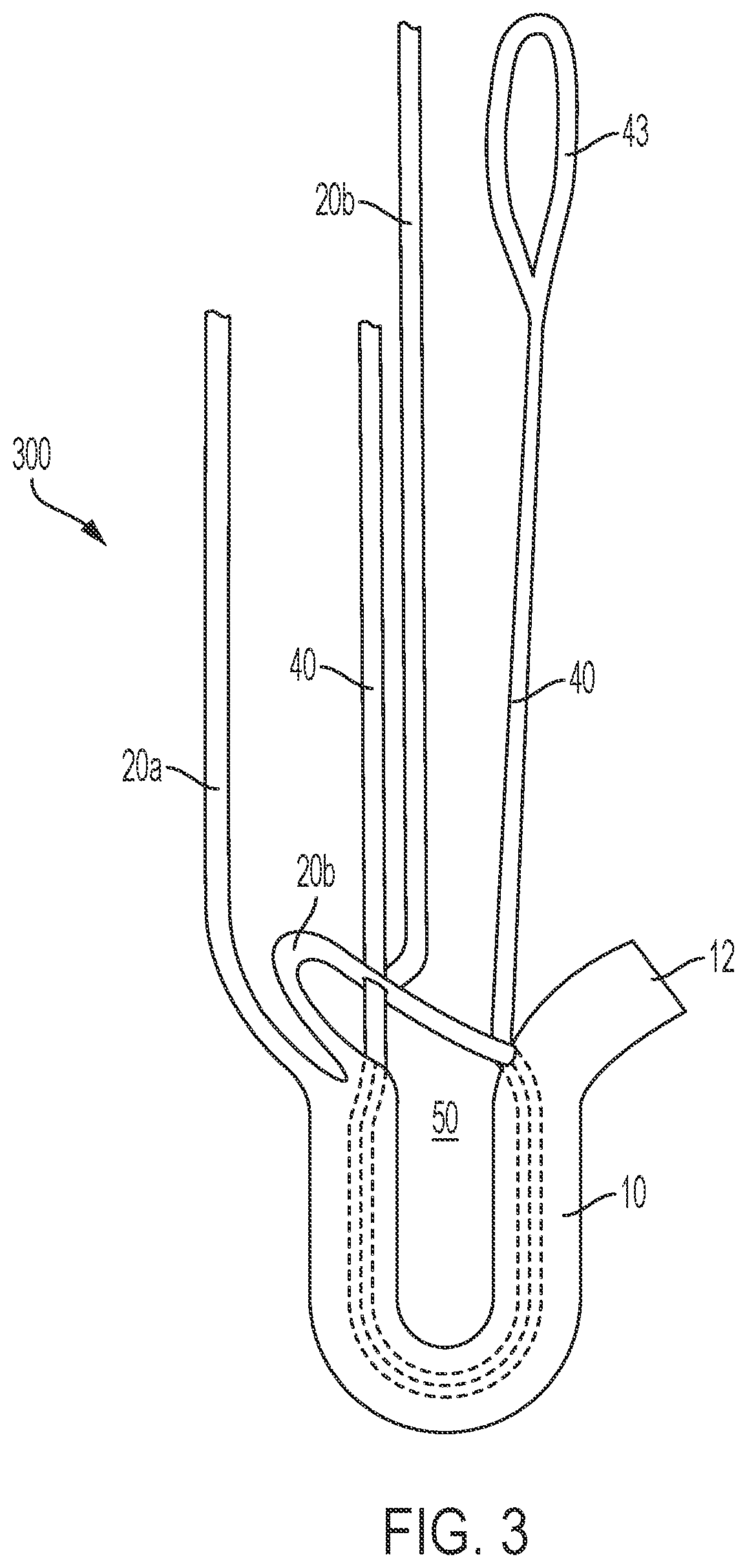 Patent US12396715 Figure 3 – Tensionable knotless anchors and methods of tissue repair