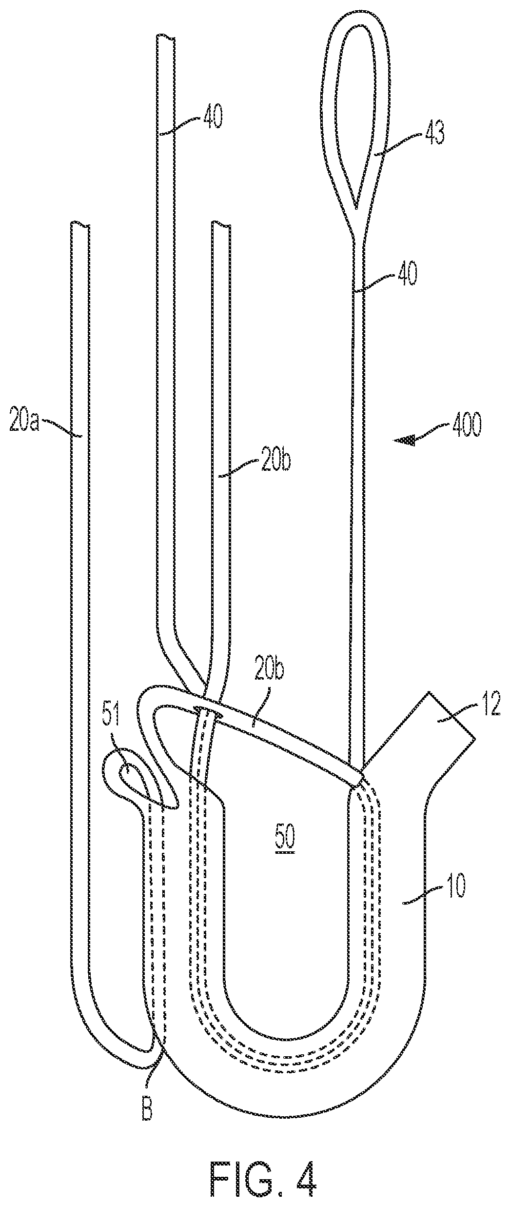 Patent US12396715 Figure 4 – Tensionable knotless anchors and methods of tissue repair