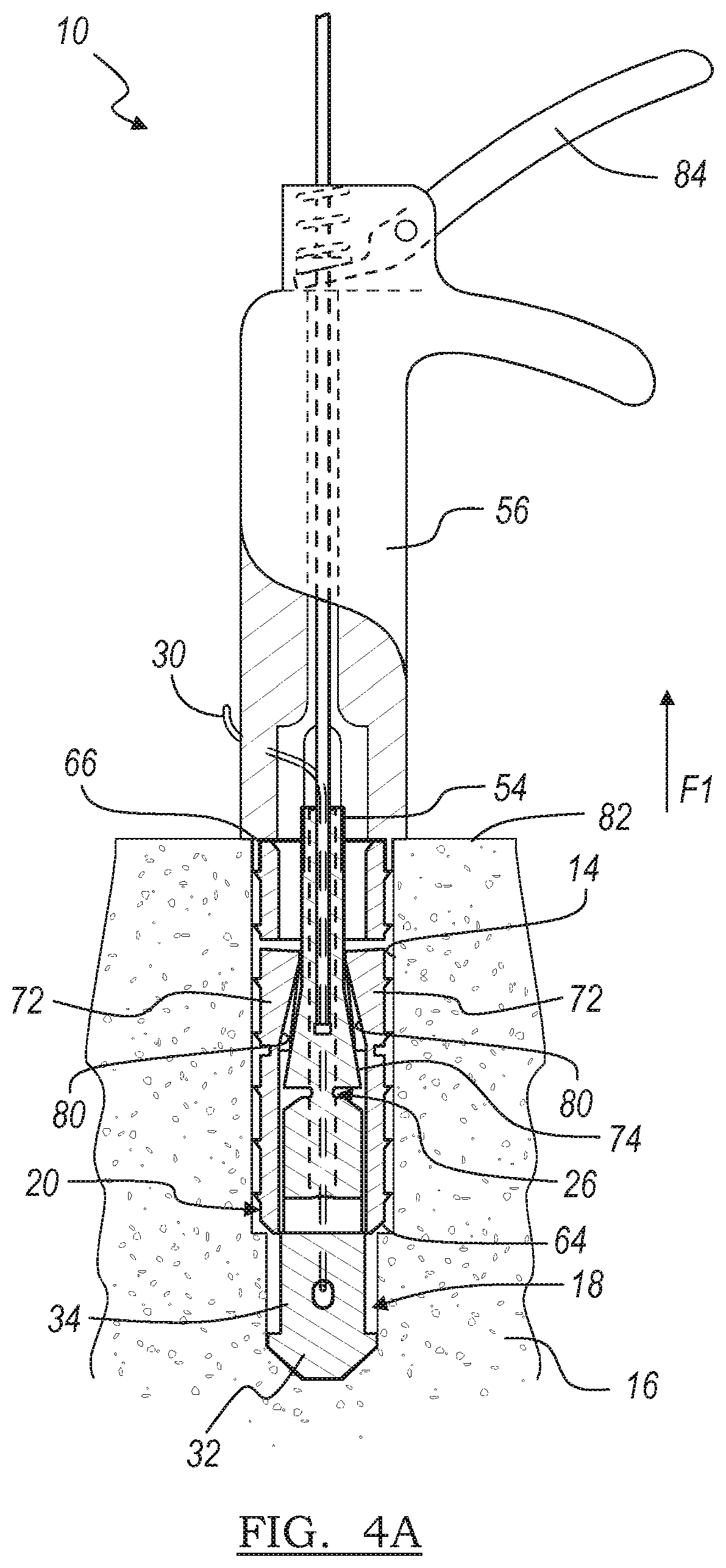 Patent US12396716 Figure 3 – Expanding suture anchor having an actuator pin