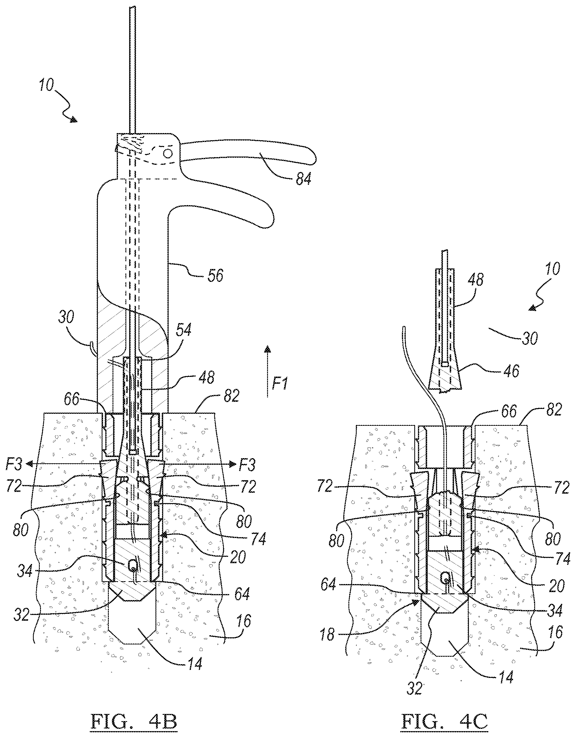 Patent US12396716 Figure 4 – Expanding suture anchor having an actuator pin