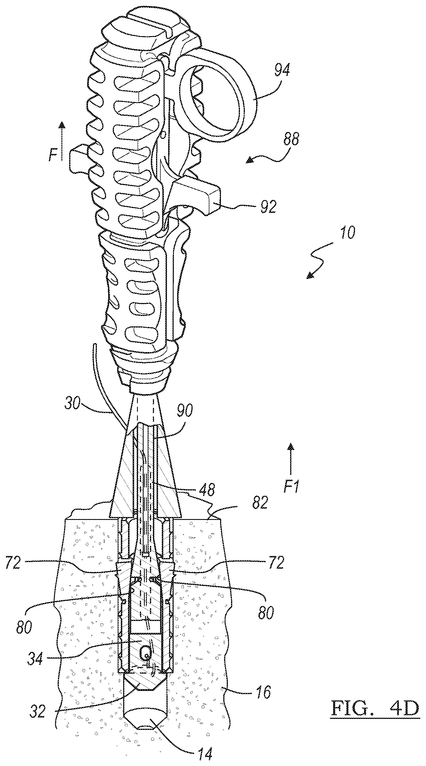 Patent US12396716 Figure 5 – Expanding suture anchor having an actuator pin