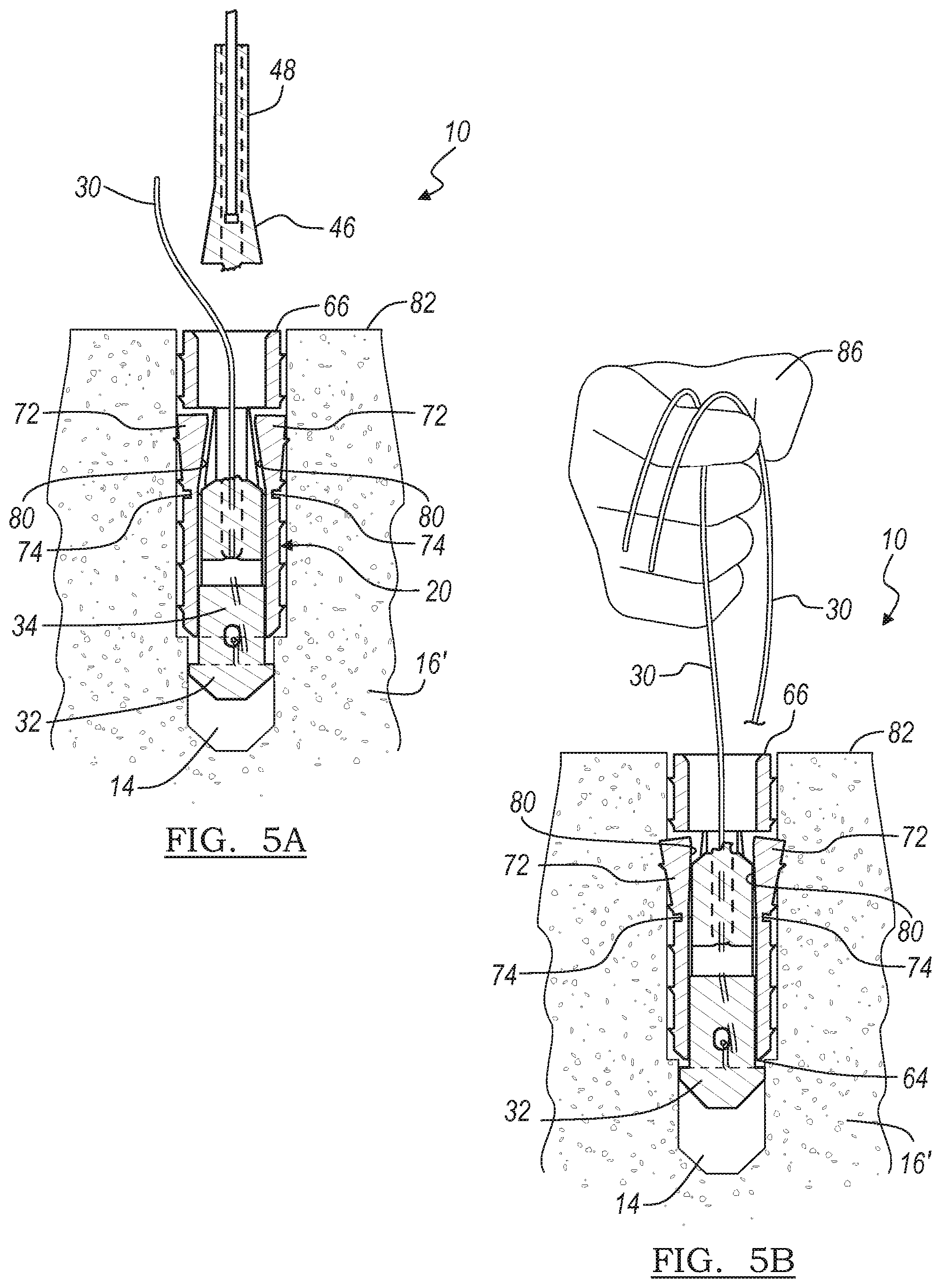 Patent US12396716 Figure 6 – Expanding suture anchor having an actuator pin