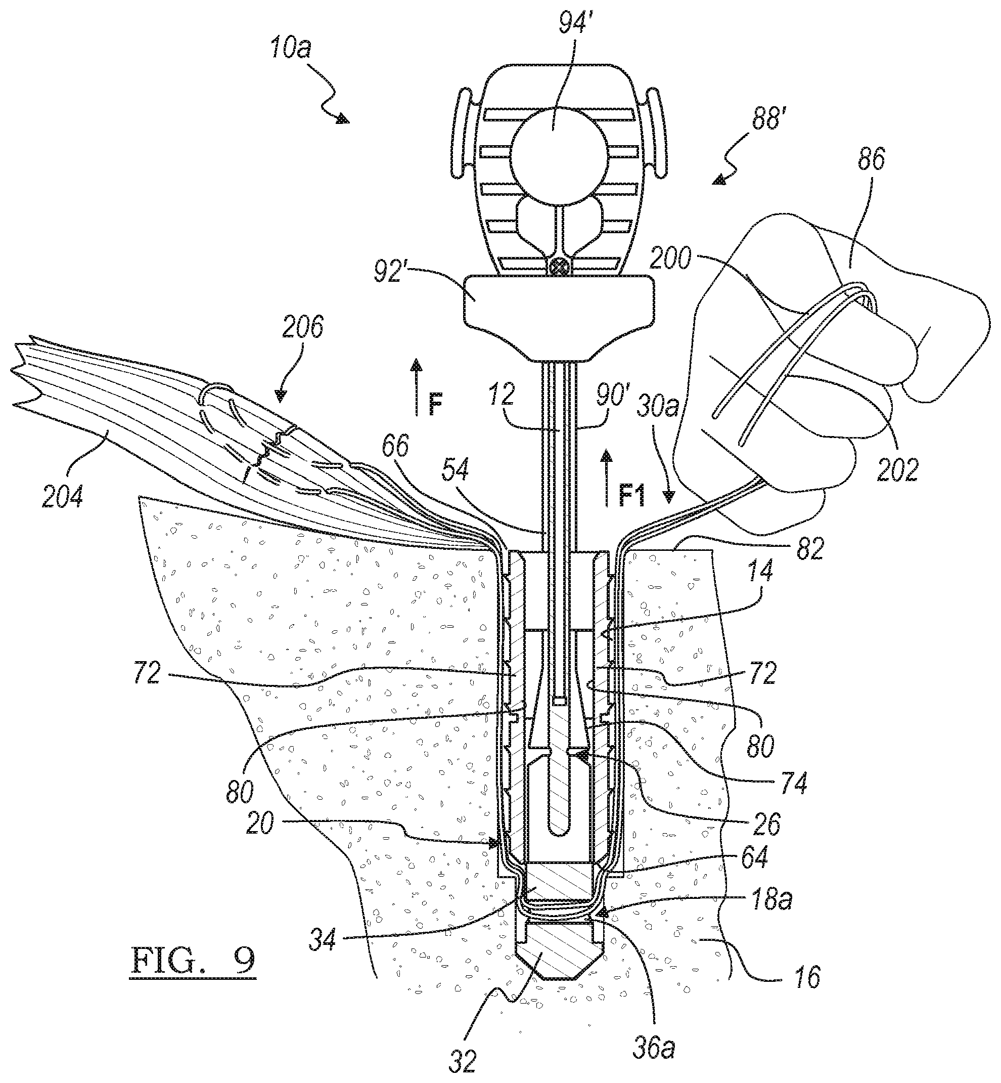 Patent US12396716 Figure 9 – Expanding suture anchor having an actuator pin