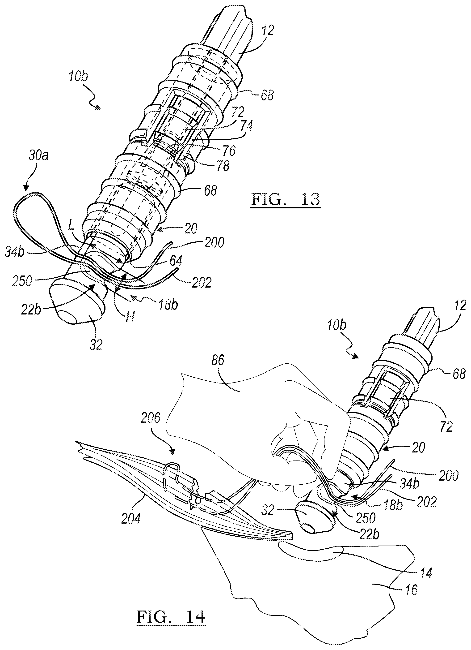 Patent US12396716 Figure 12 – Expanding suture anchor having an actuator pin