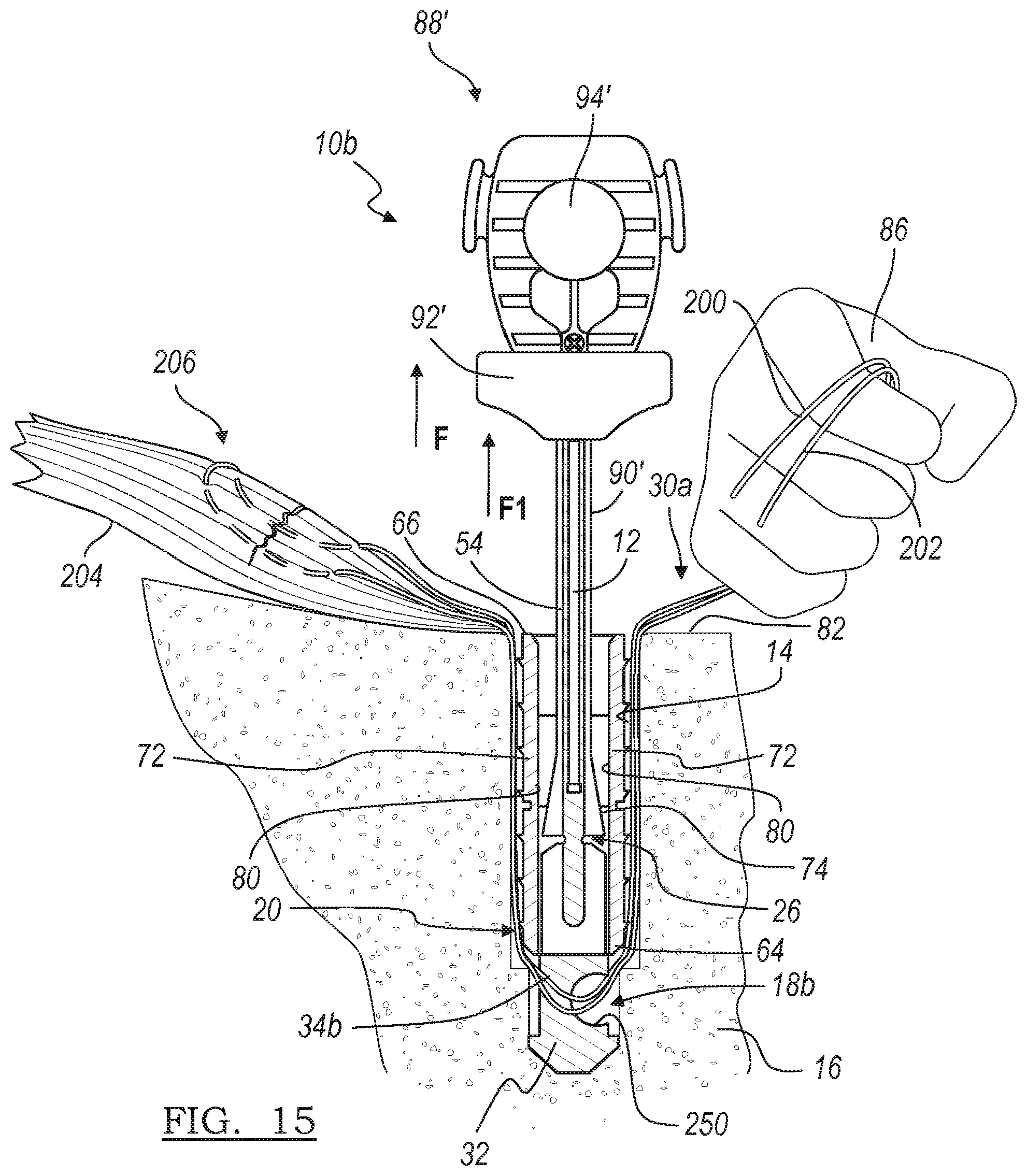 Patent US12396716 Figure 13 – Expanding suture anchor having an actuator pin