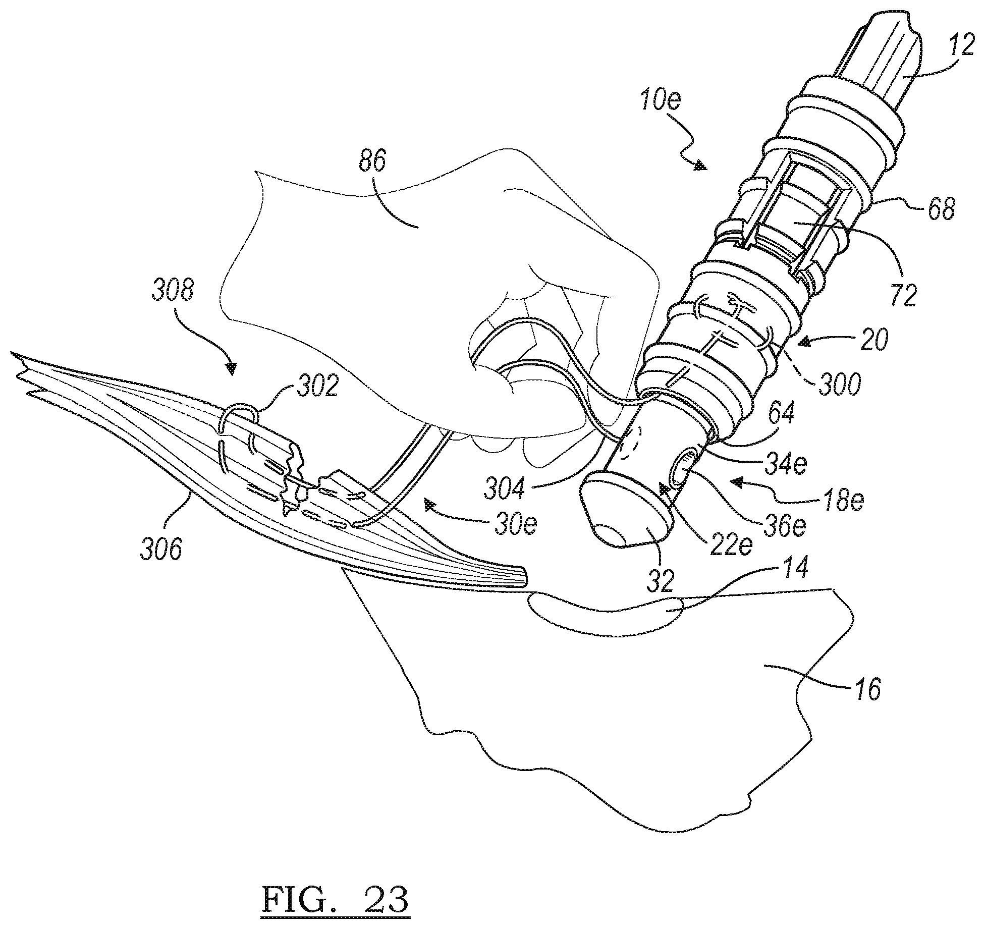 Patent US12396716 Figure 18 – Expanding suture anchor having an actuator pin
