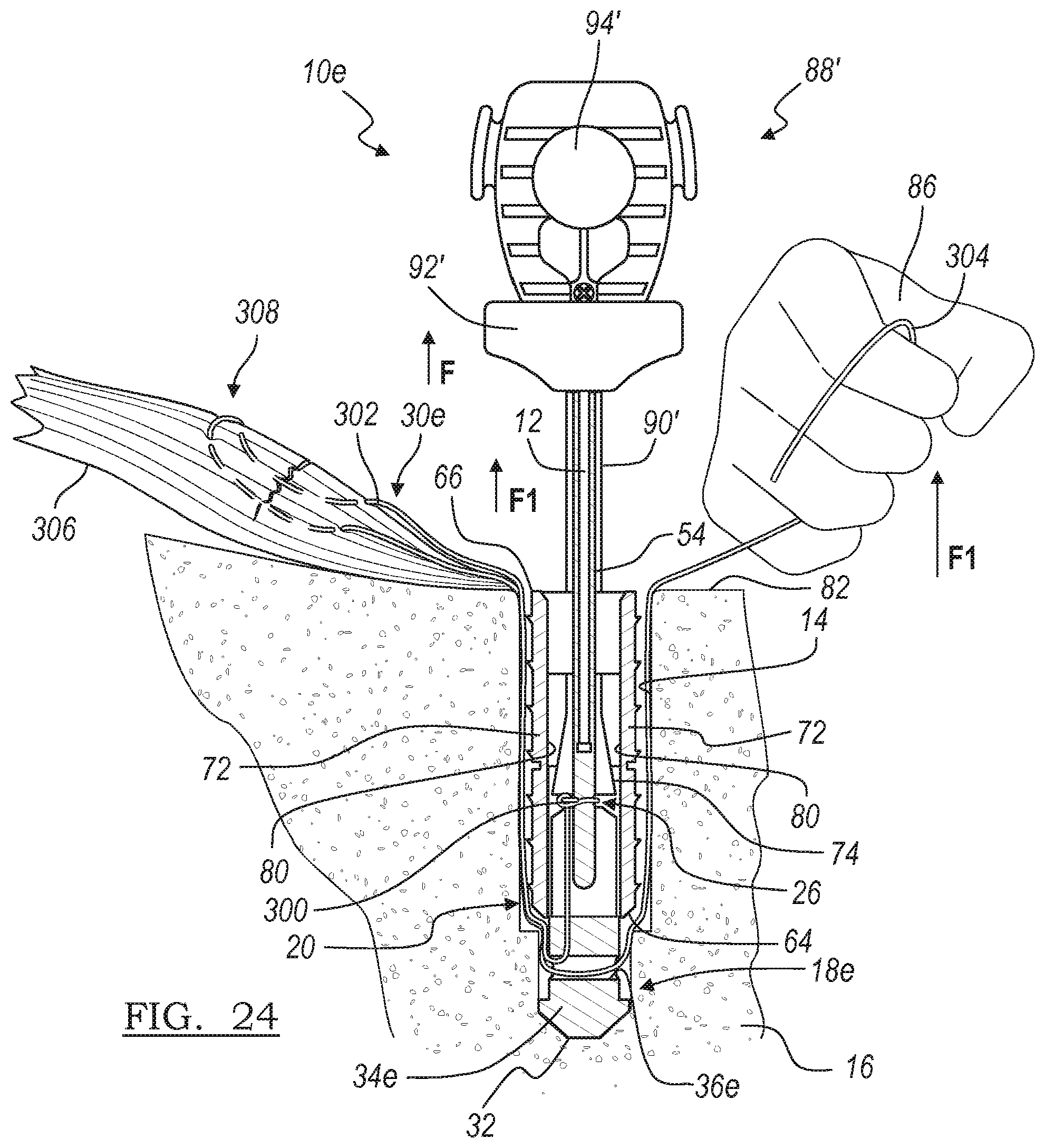 Patent US12396716 Figure 19 – Expanding suture anchor having an actuator pin