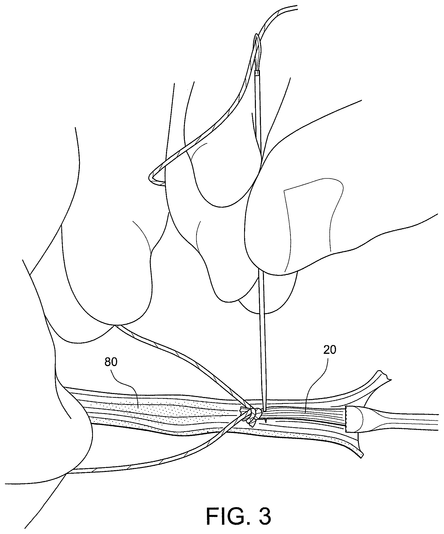 Patent US12396717 Figure 2 – Methods of making reinforced soft tissue grafts with suture loop/needle constructs
