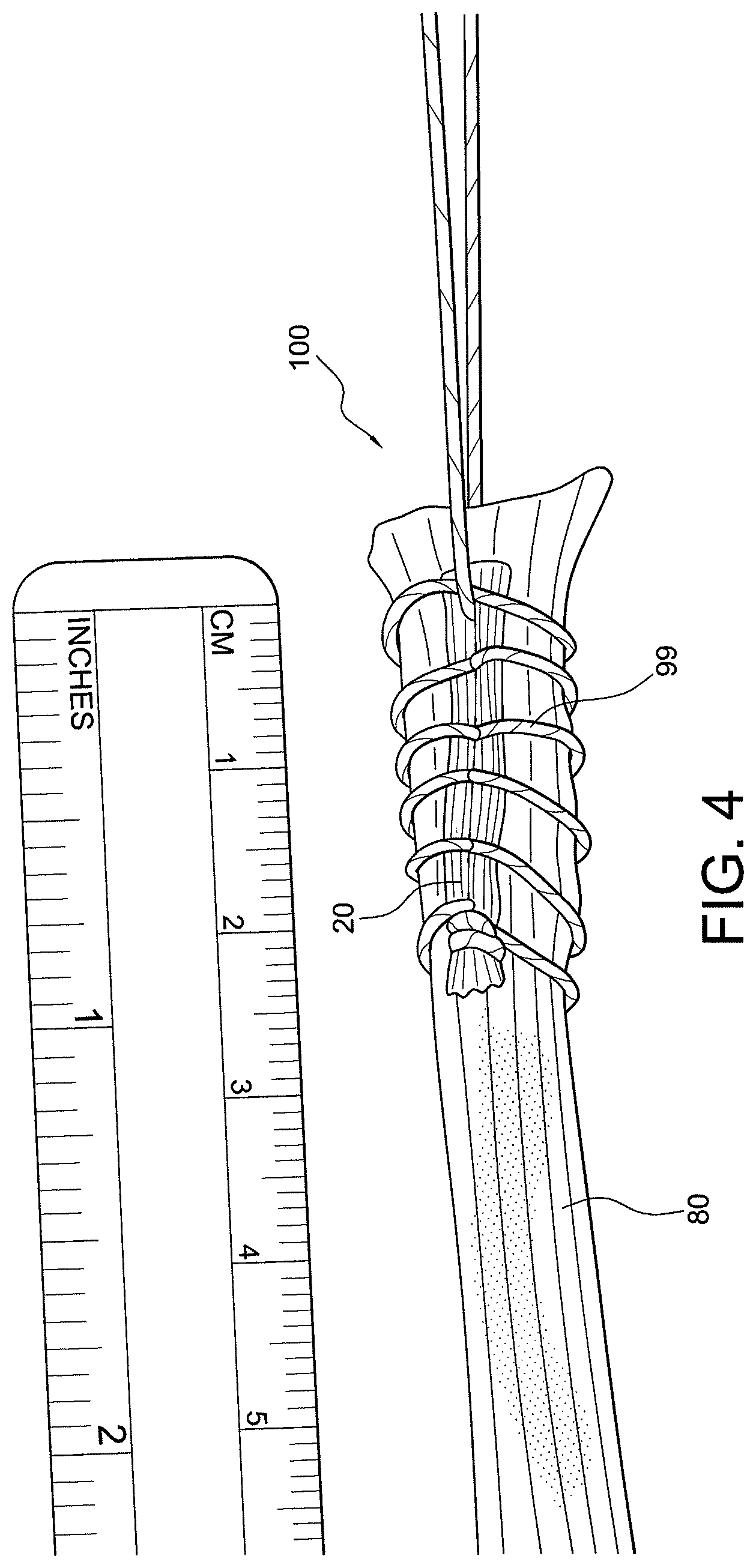 Patent US12396717 Figure 3 – Methods of making reinforced soft tissue grafts with suture loop/needle constructs