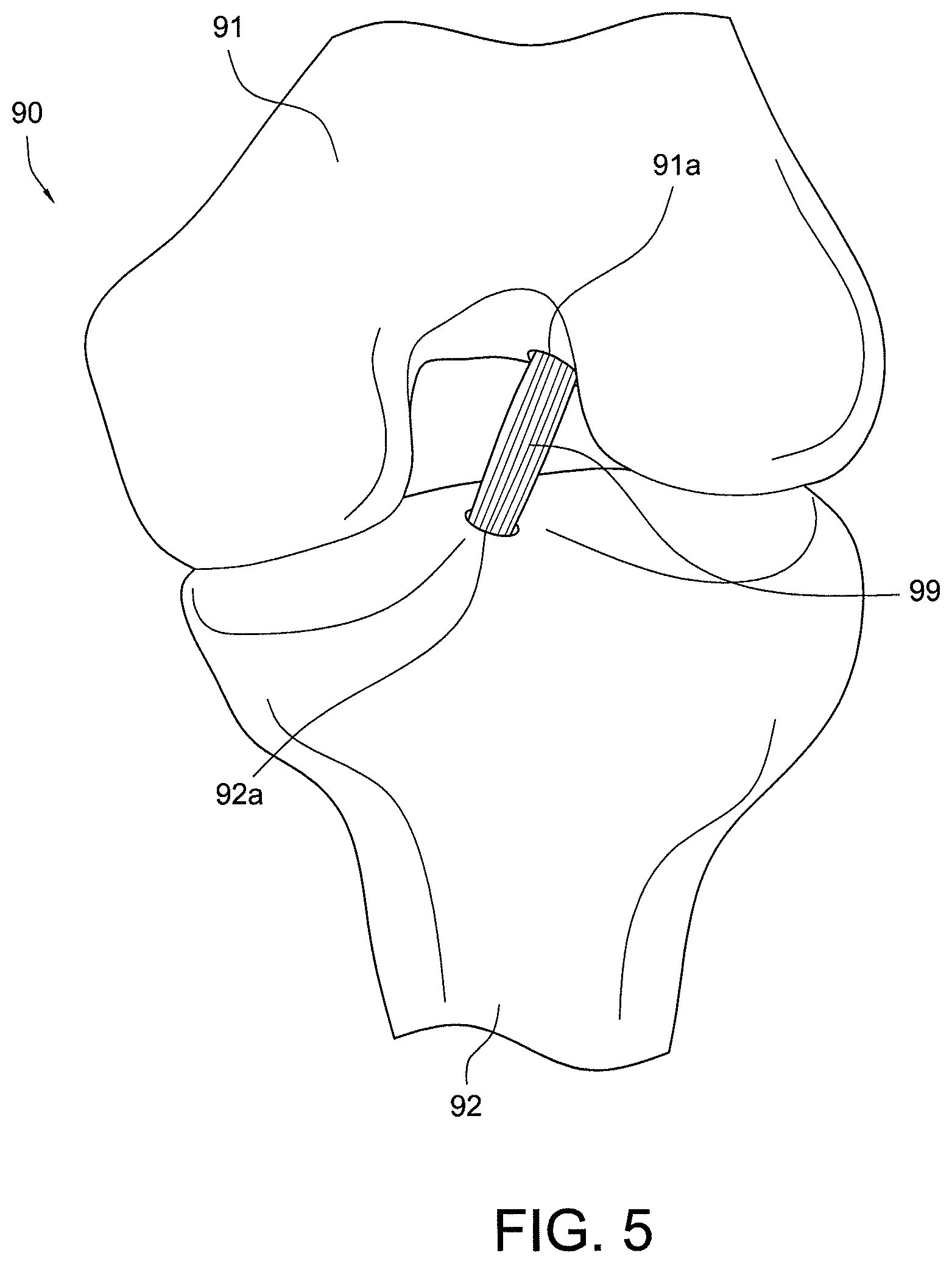 Patent US12396717 Figure 4 – Methods of making reinforced soft tissue grafts with suture loop/needle constructs