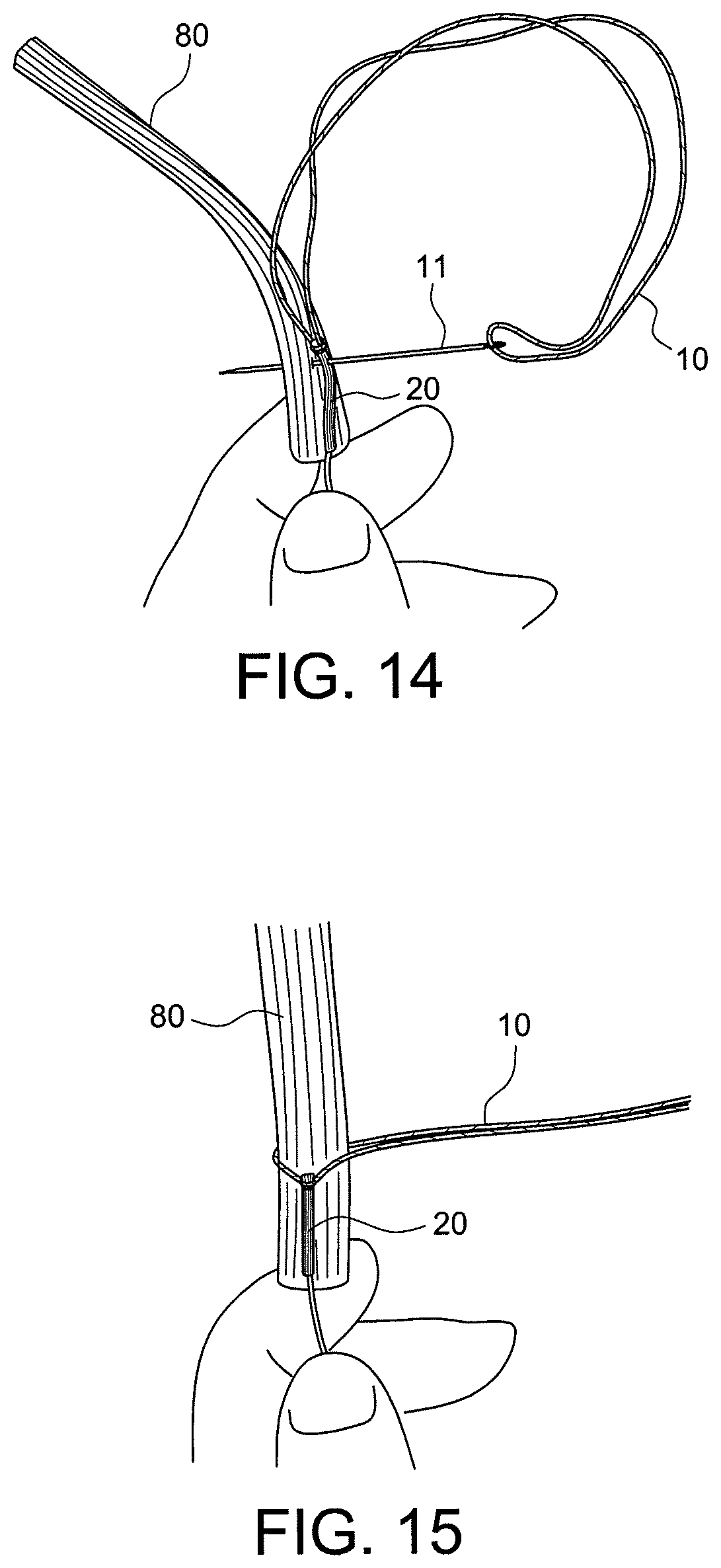 Patent US12396717 Figure 8 – Methods of making reinforced soft tissue grafts with suture loop/needle constructs