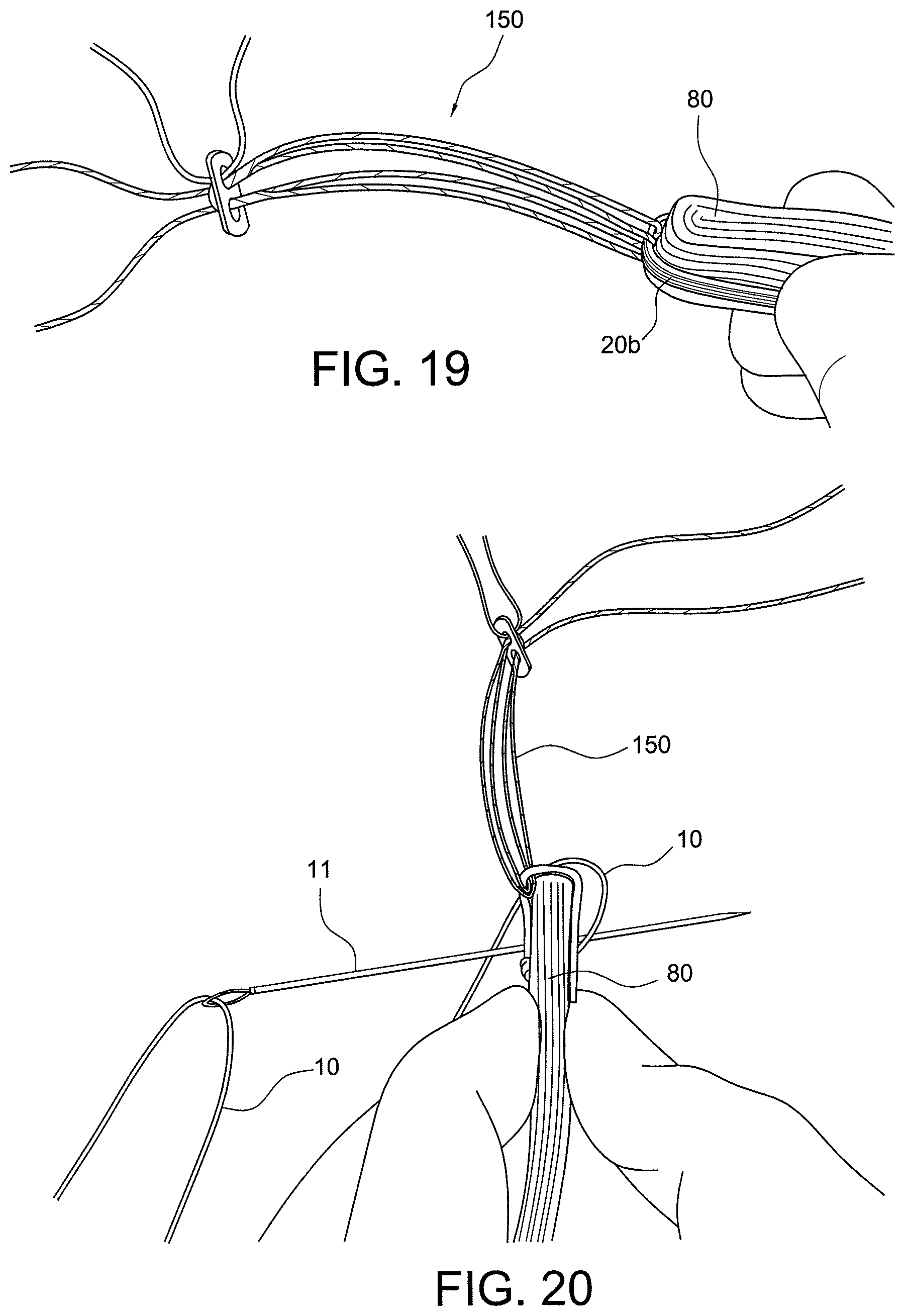 Patent US12396717 Figure 10 – Methods of making reinforced soft tissue grafts with suture loop/needle constructs