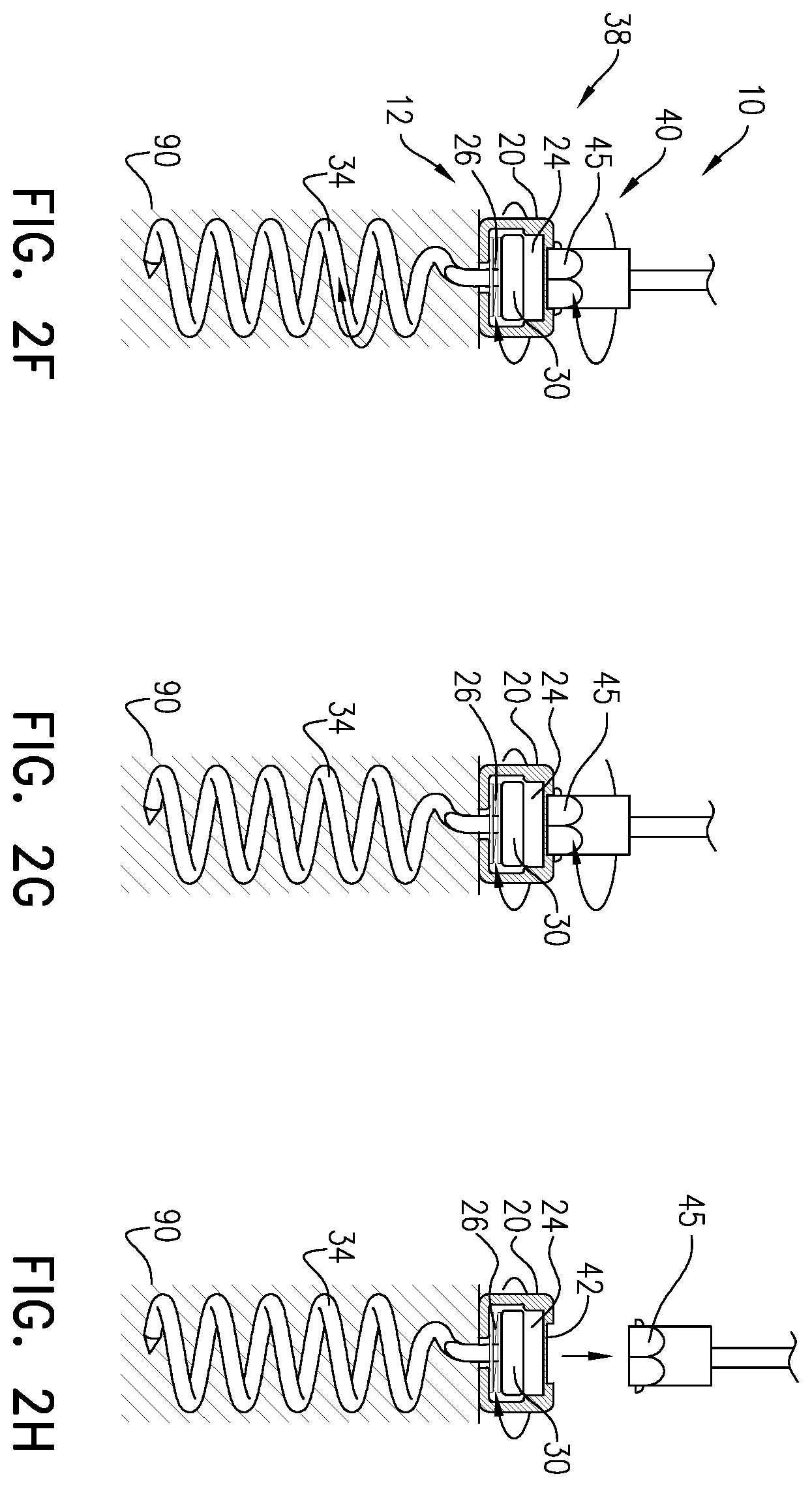 Patent US12396718 Figure 4 – Self-stopping tissue anchors